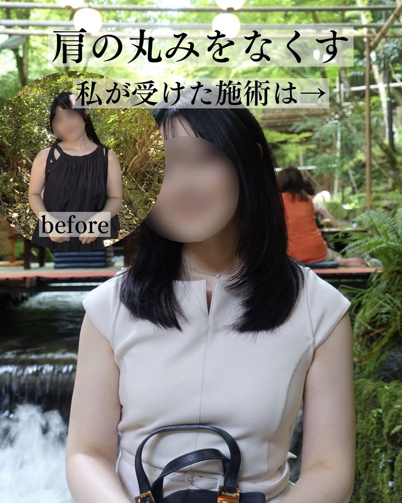 二の腕脂肪吸引ー症例写真