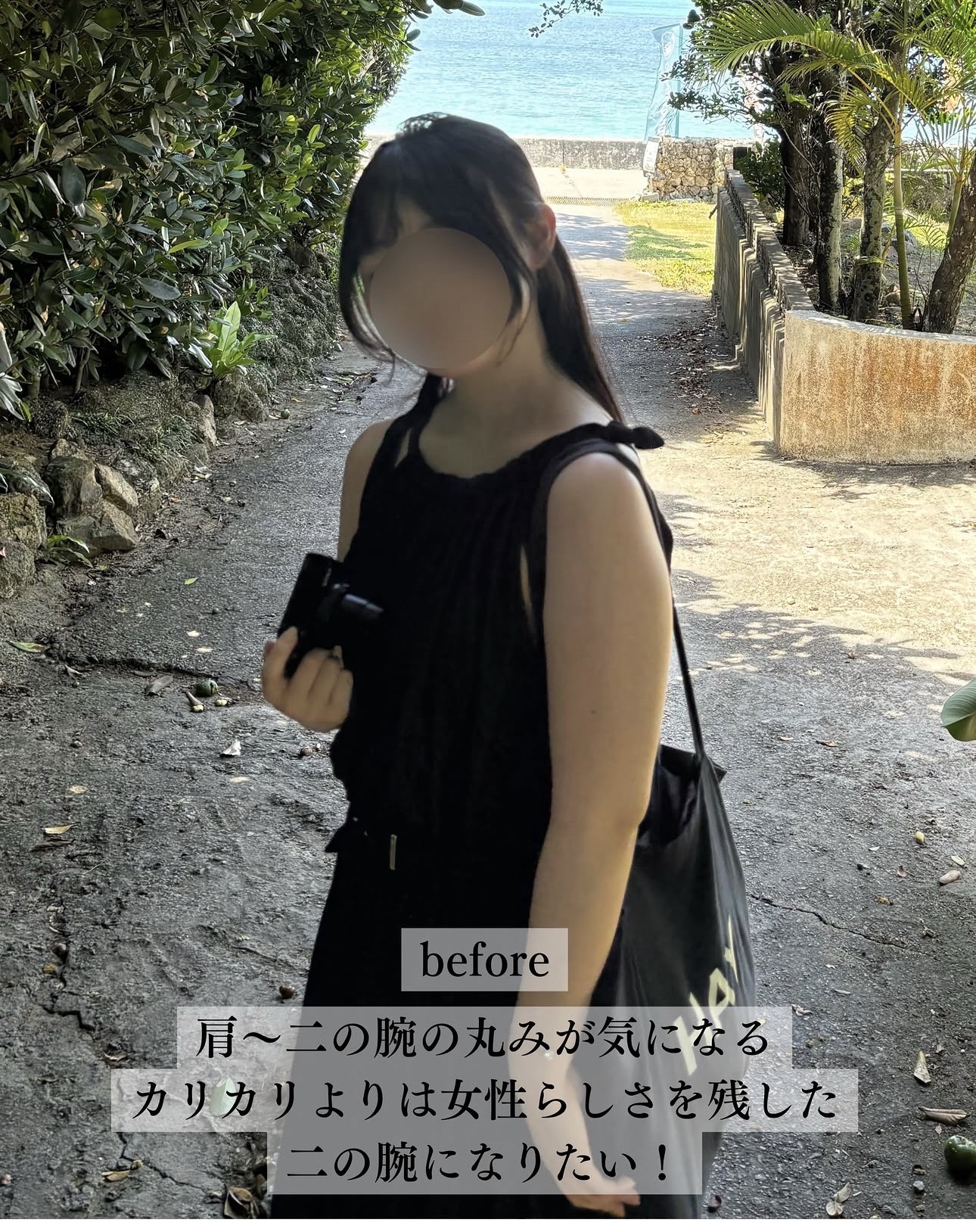 二の腕脂肪吸引ー症例写真