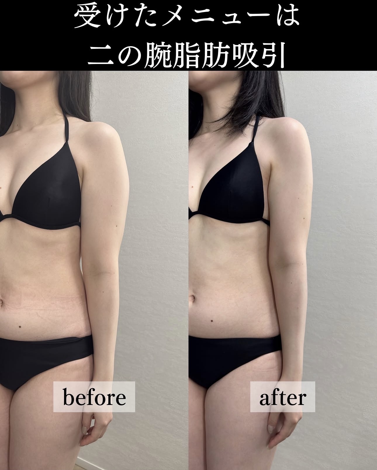 二の腕脂肪吸引ー症例写真