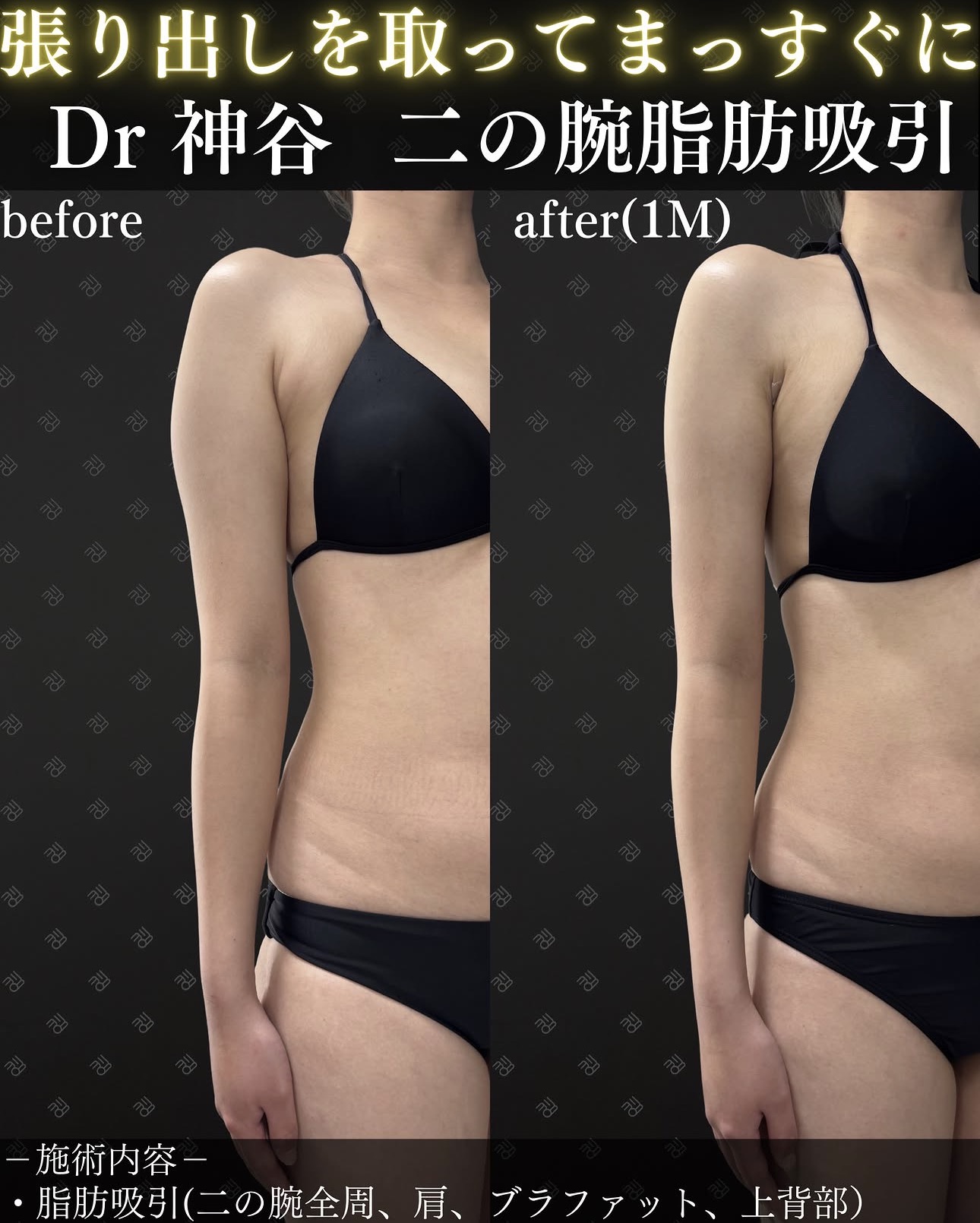 二の腕脂肪吸引ー症例写真