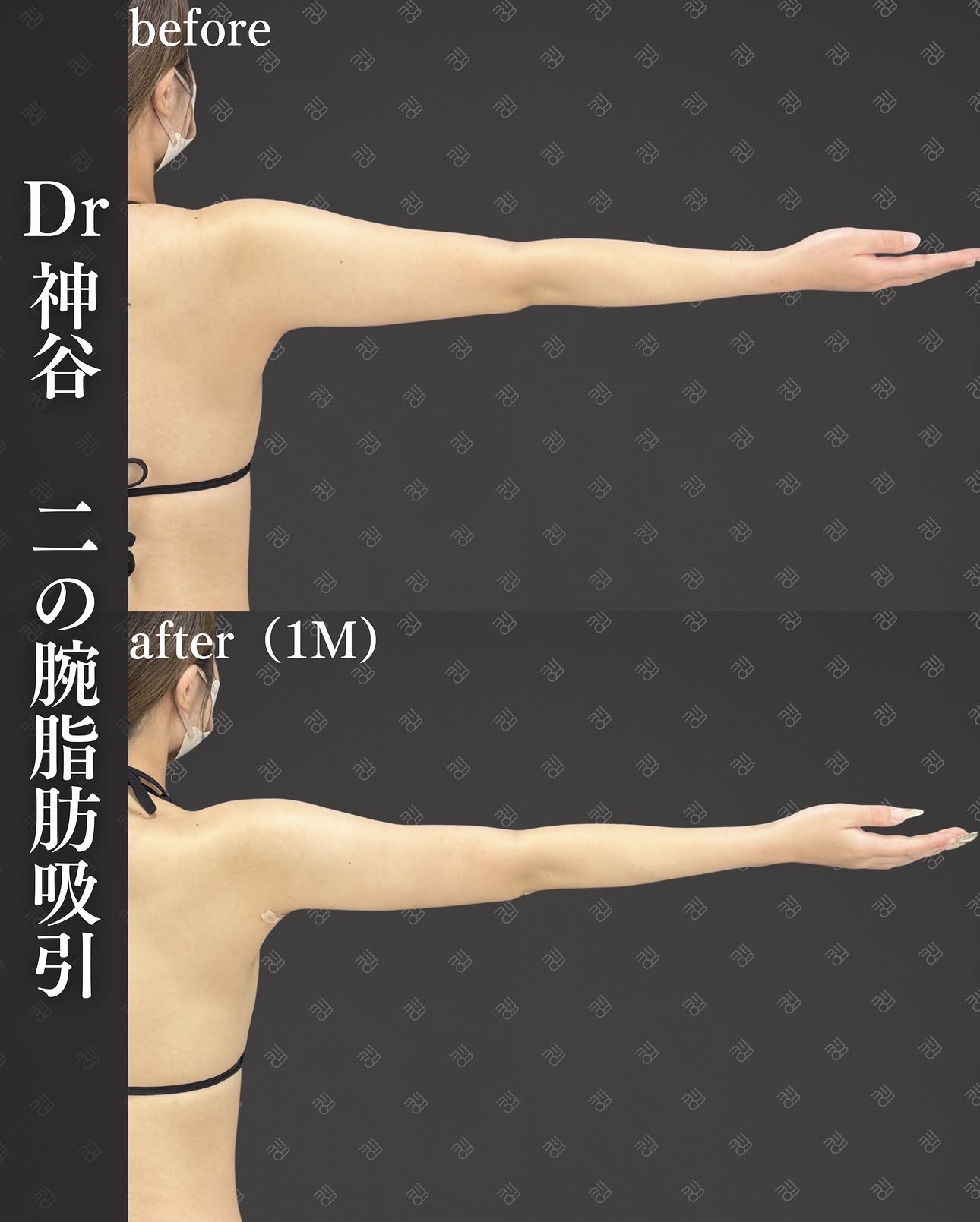 二の腕脂肪吸引ー症例写真