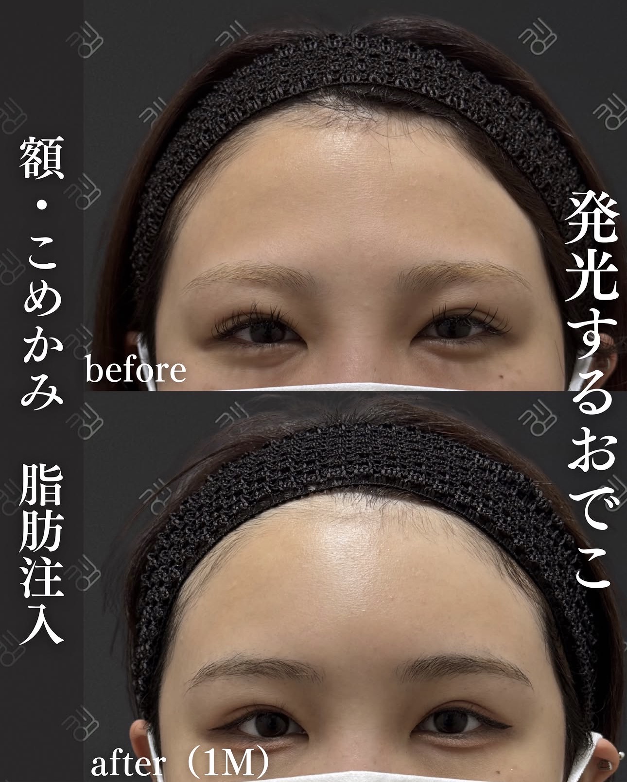 脂肪注入ー症例写真
