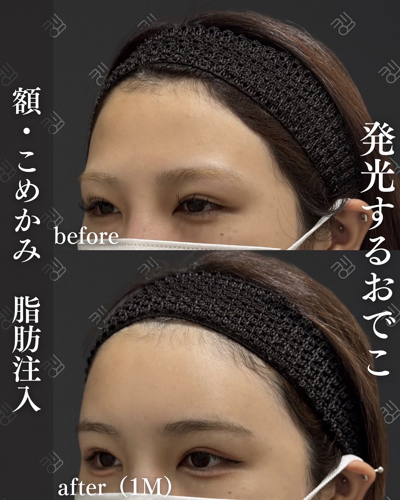 脂肪注入ー症例写真