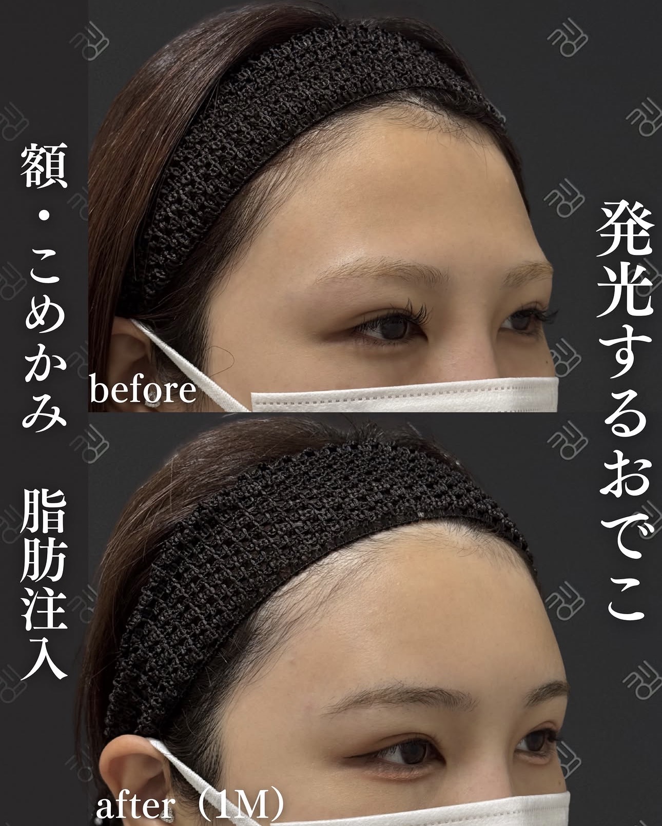 脂肪注入ー症例写真