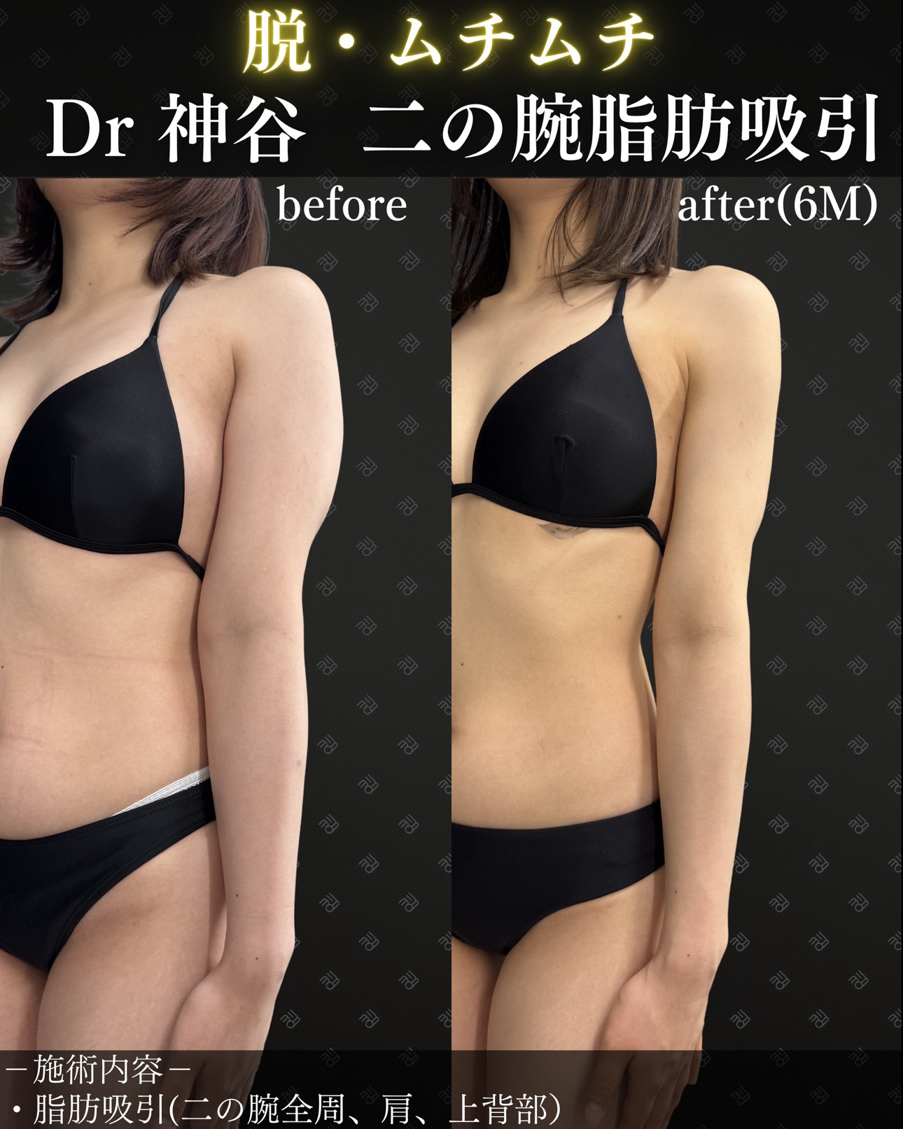二の腕脂肪吸引ー症例写真