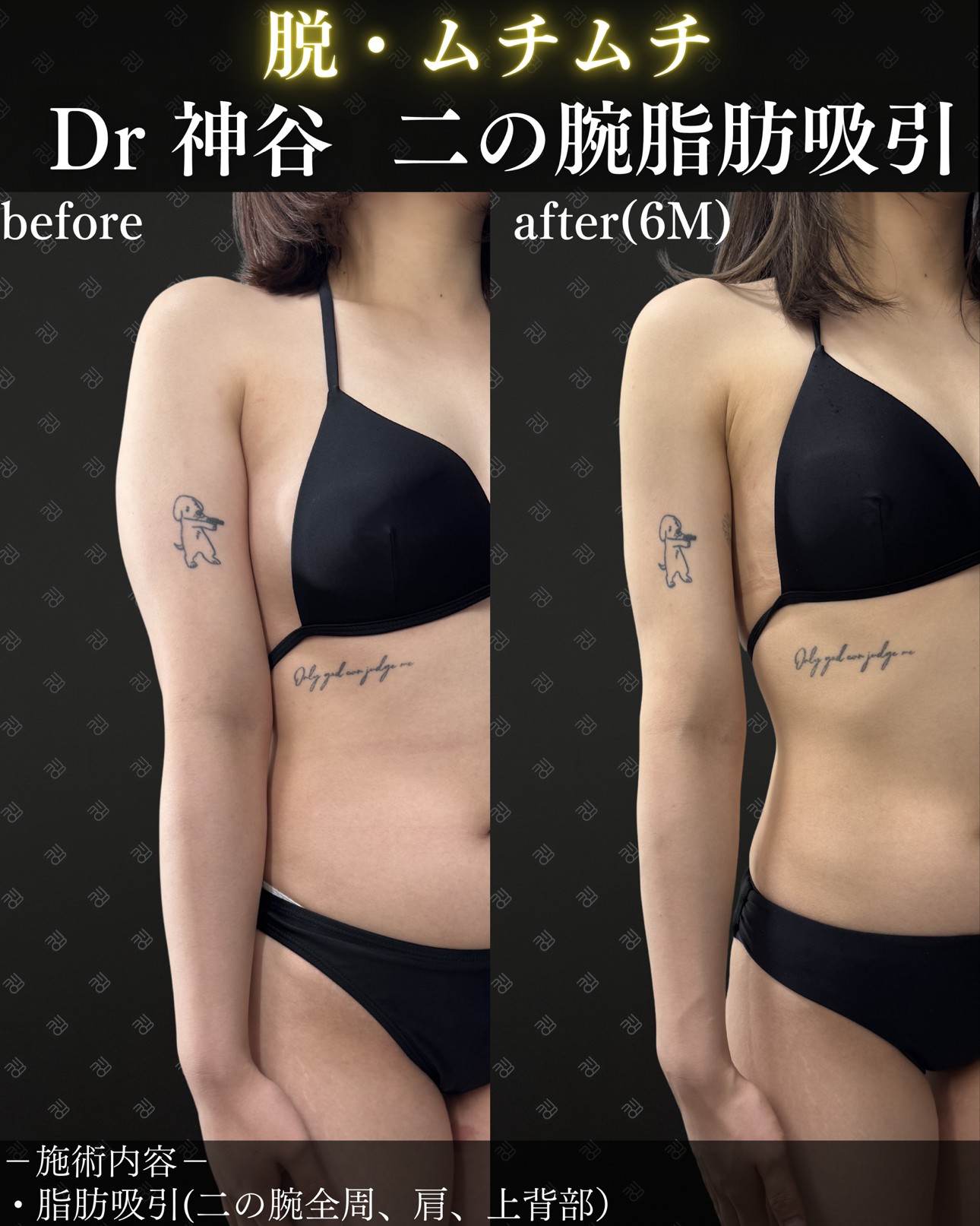 二の腕脂肪吸引ー症例写真
