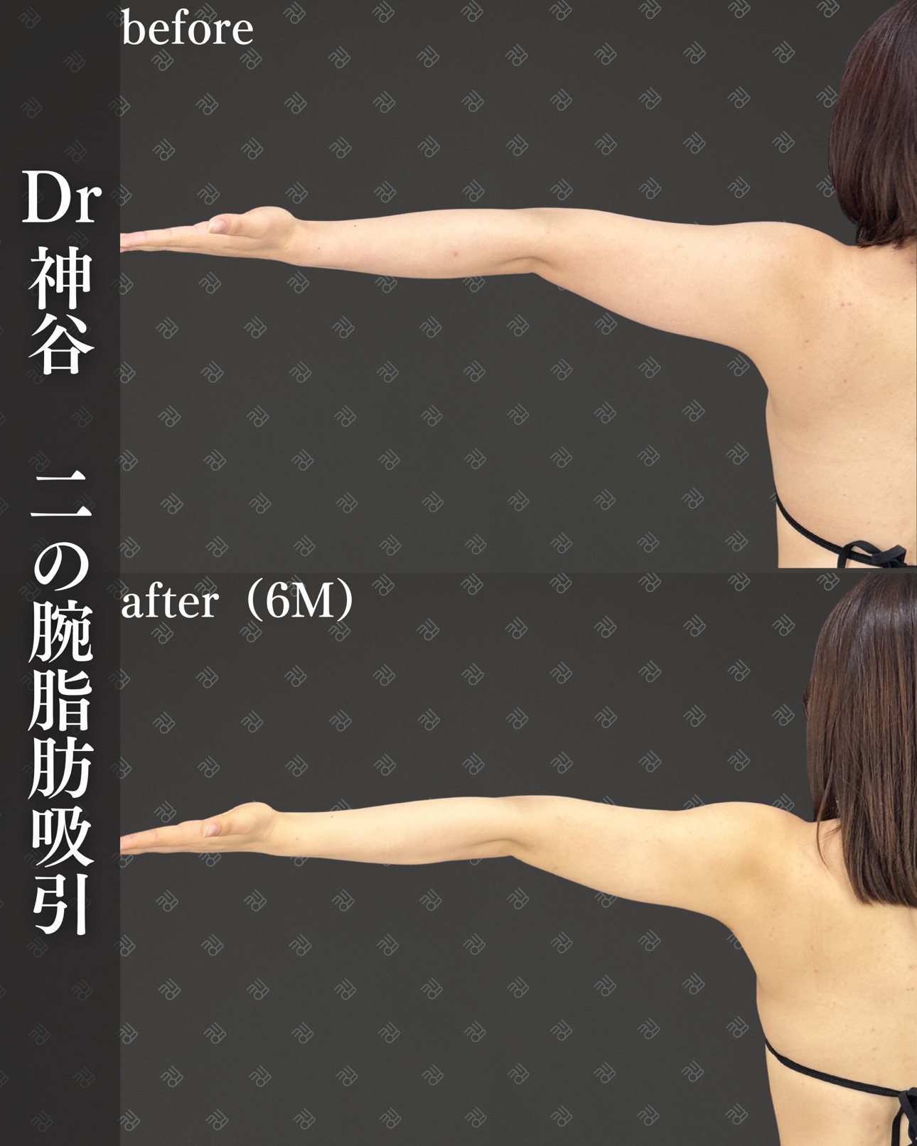 二の腕脂肪吸引ー症例写真
