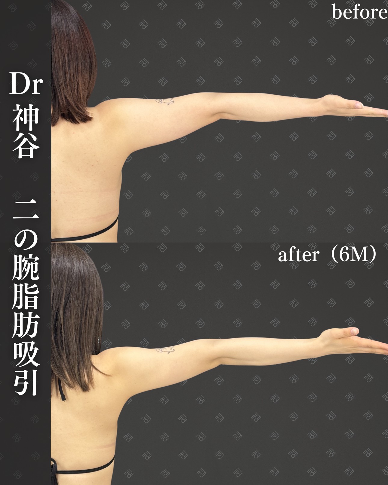 二の腕脂肪吸引ー症例写真