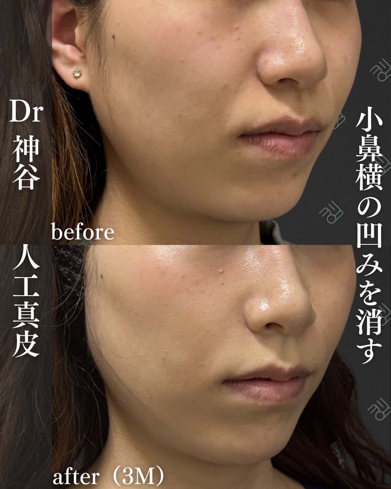 ヒアルロン酸ー症例写真