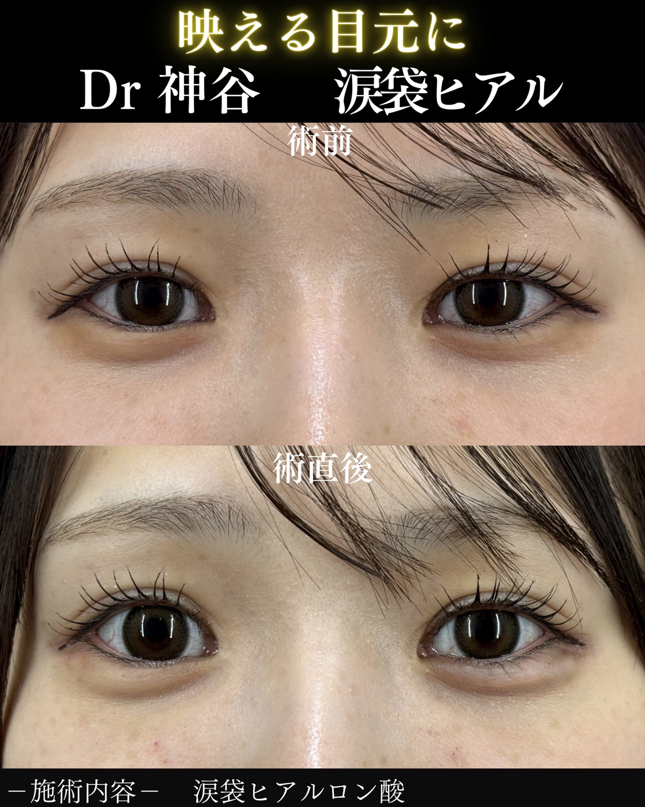 二の腕脂肪吸引ー症例写真