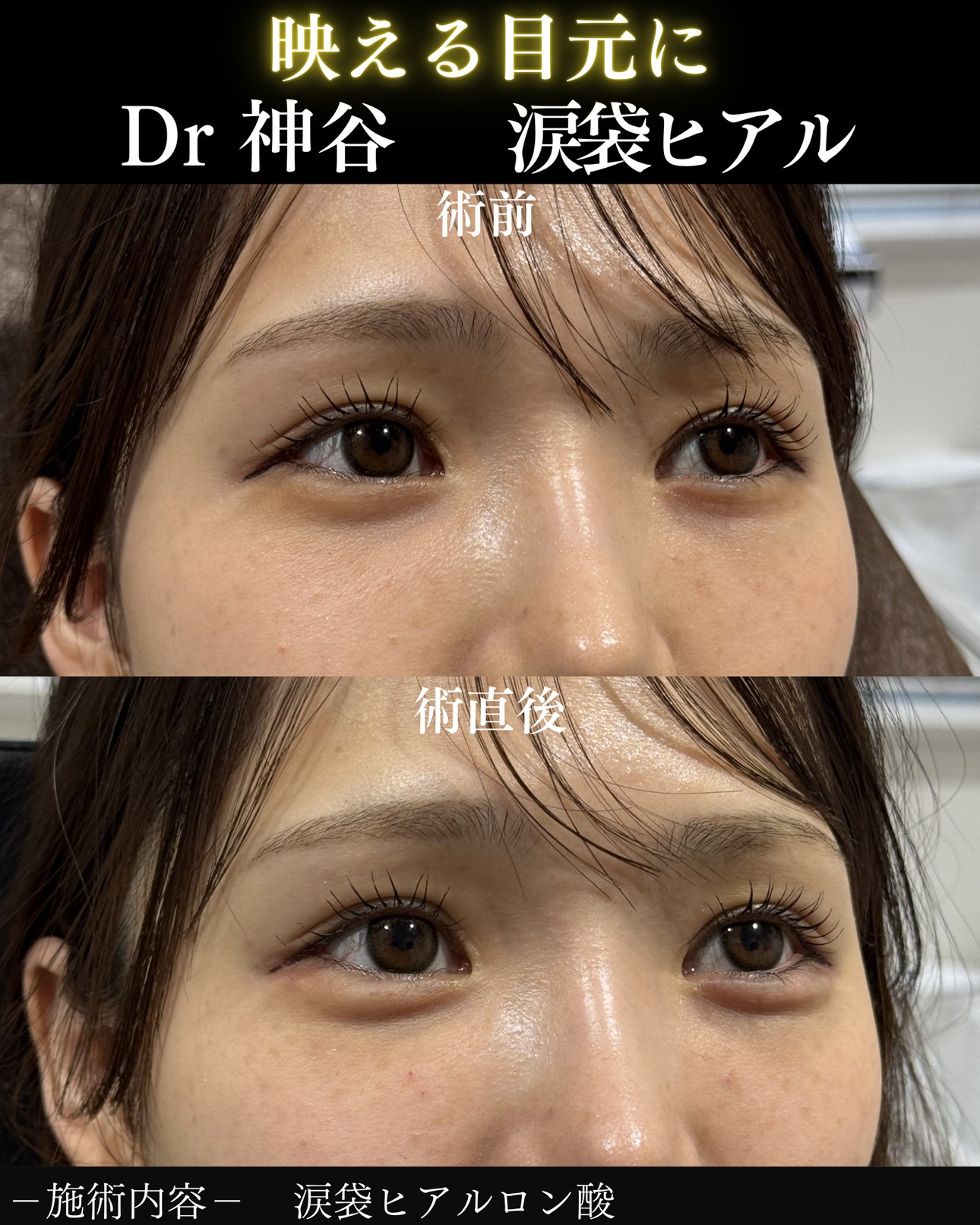 二の腕脂肪吸引ー症例写真