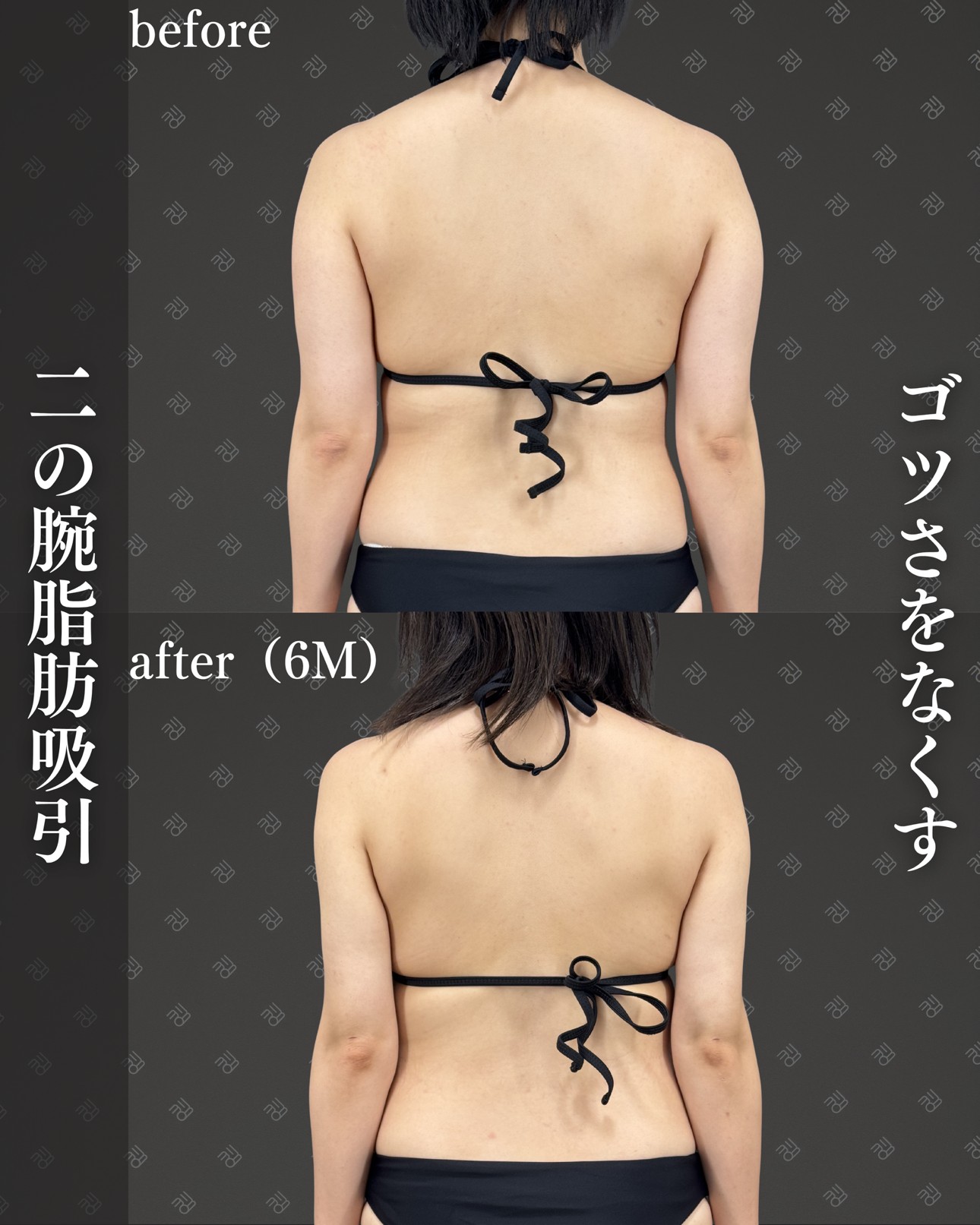 二の腕脂肪吸引ー症例写真
