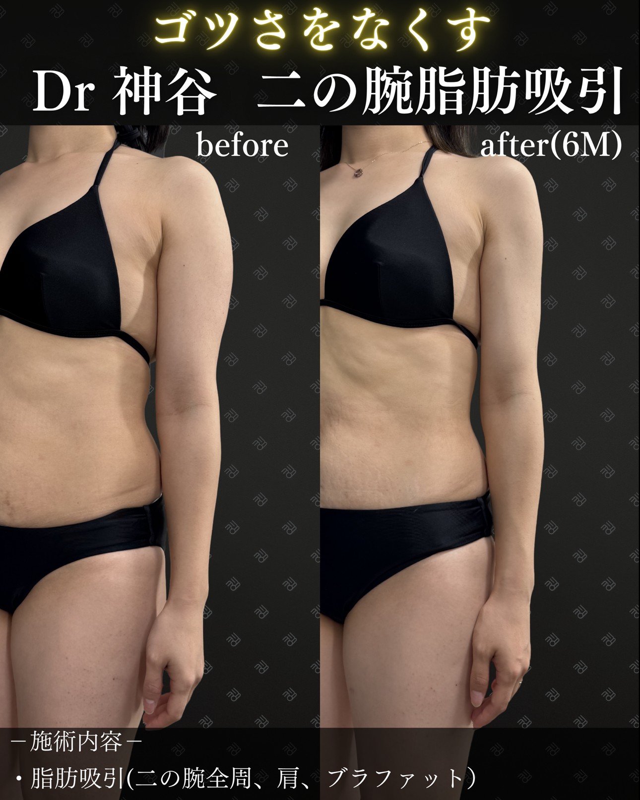 二の腕脂肪吸引ー症例写真