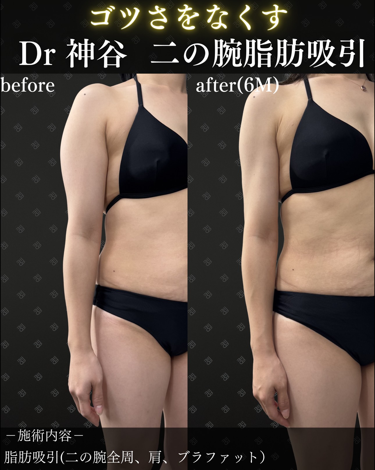 二の腕脂肪吸引ー症例写真