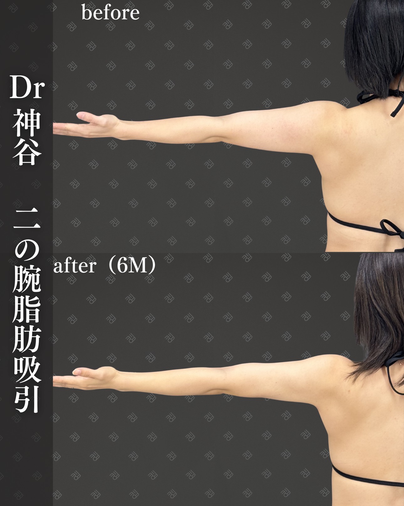 二の腕脂肪吸引ー症例写真