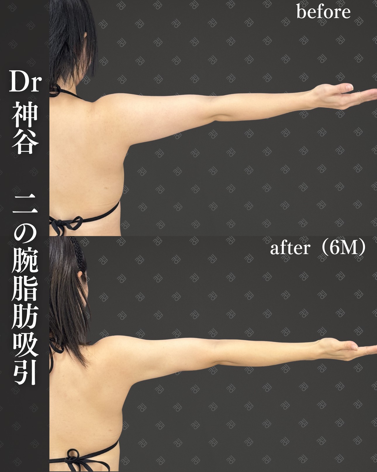 二の腕脂肪吸引ー症例写真