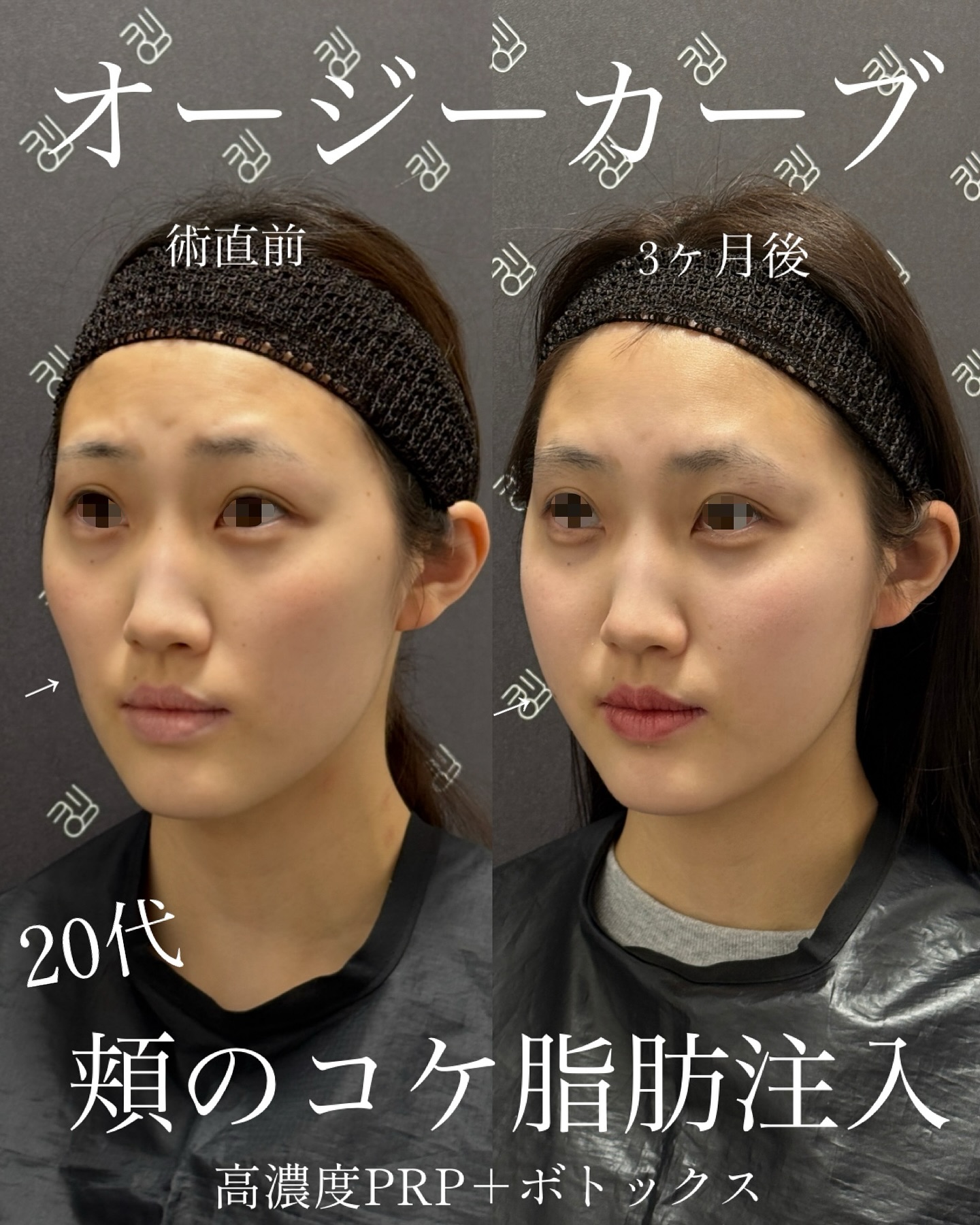 頬の脂肪注入によるビフォーアフター
