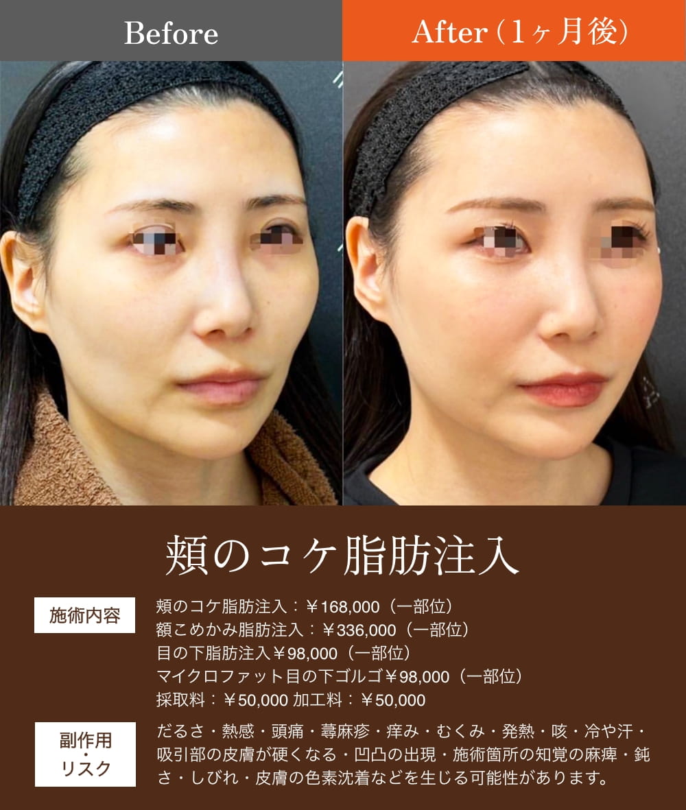 頬のコケ脂肪注入による術前と術後