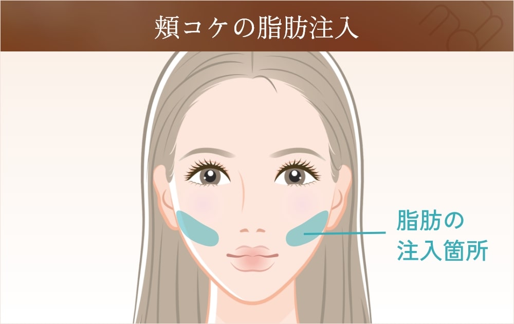  頬コケの脂肪注入