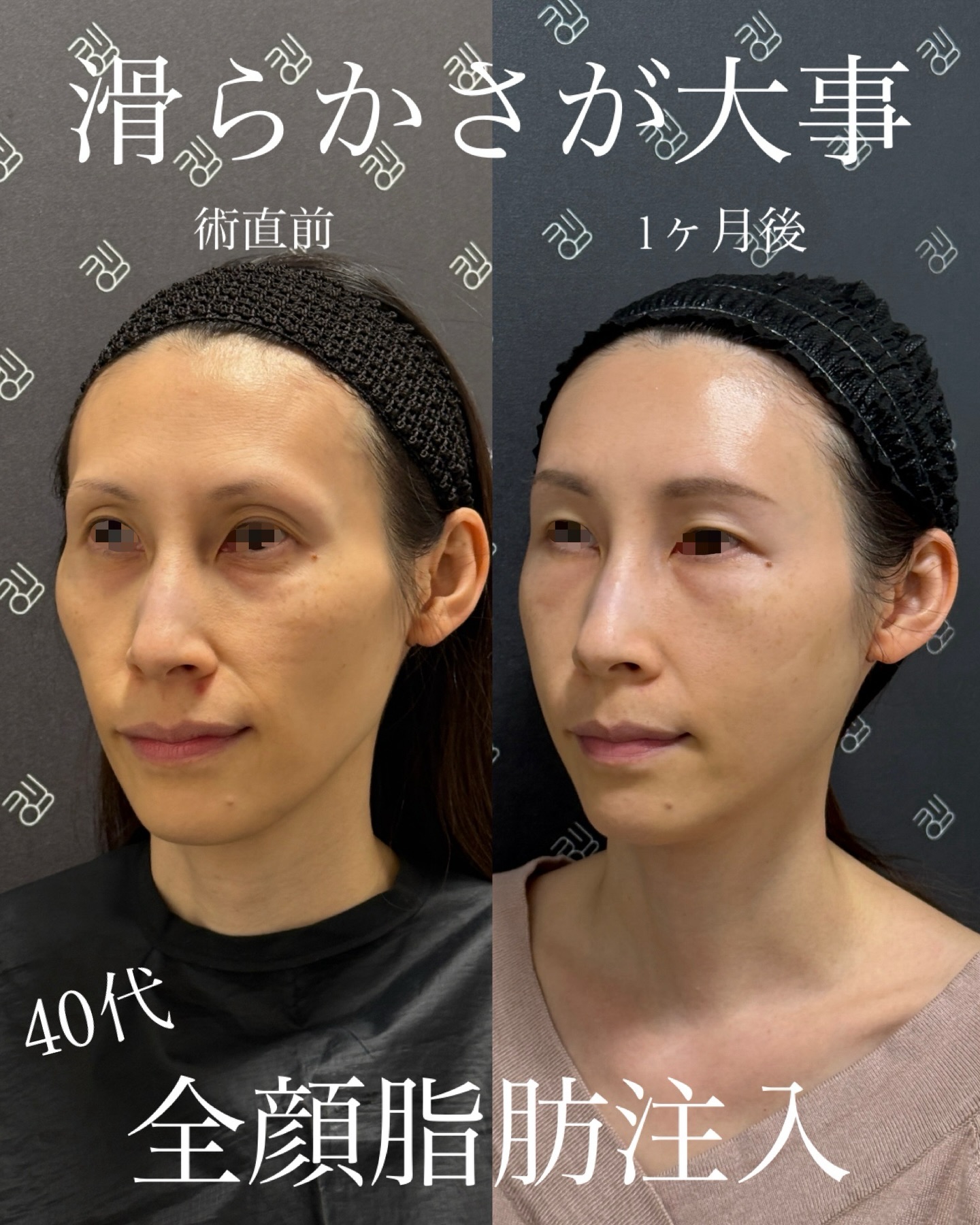 全顔脂肪注入術前と術後1ヶ月の比較
