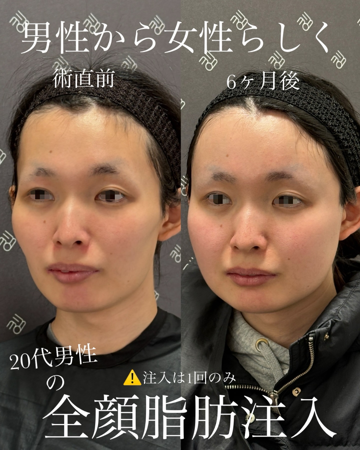 顔の脂肪注入ビフォーアフター