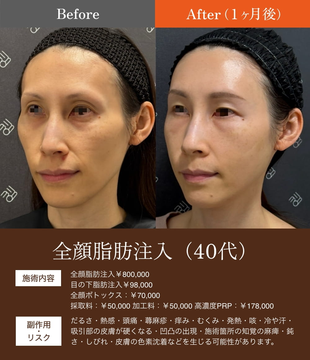 全顔脂肪注入前後の40代女性比較画像