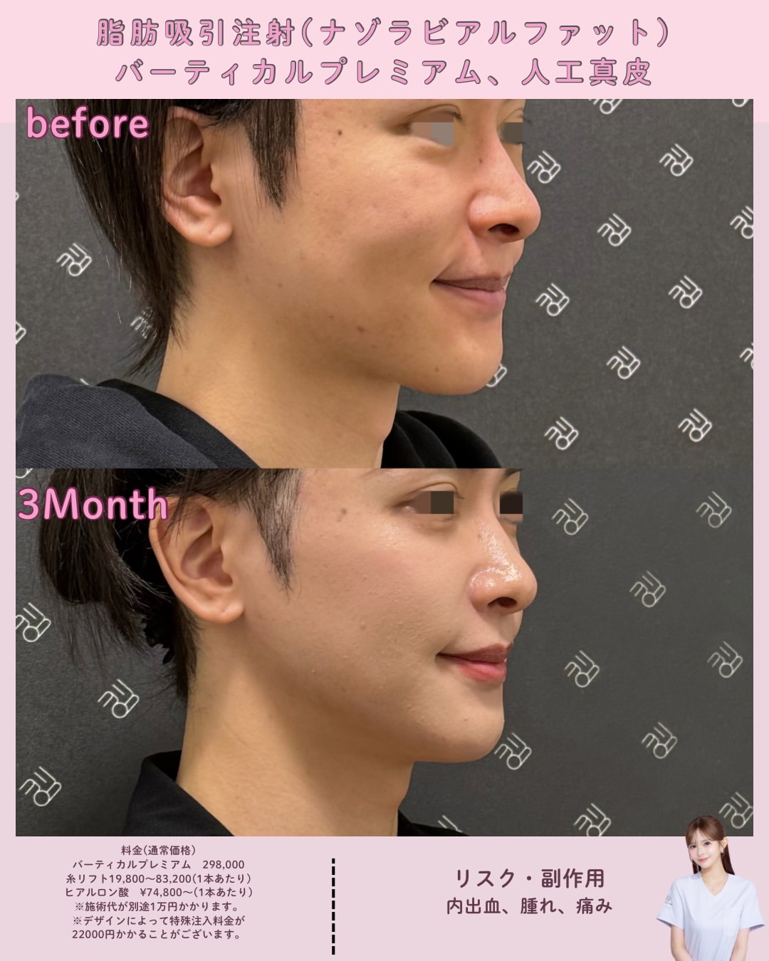 ナゾラビアルファット×バーティカルリフトプレミアム×人工真皮