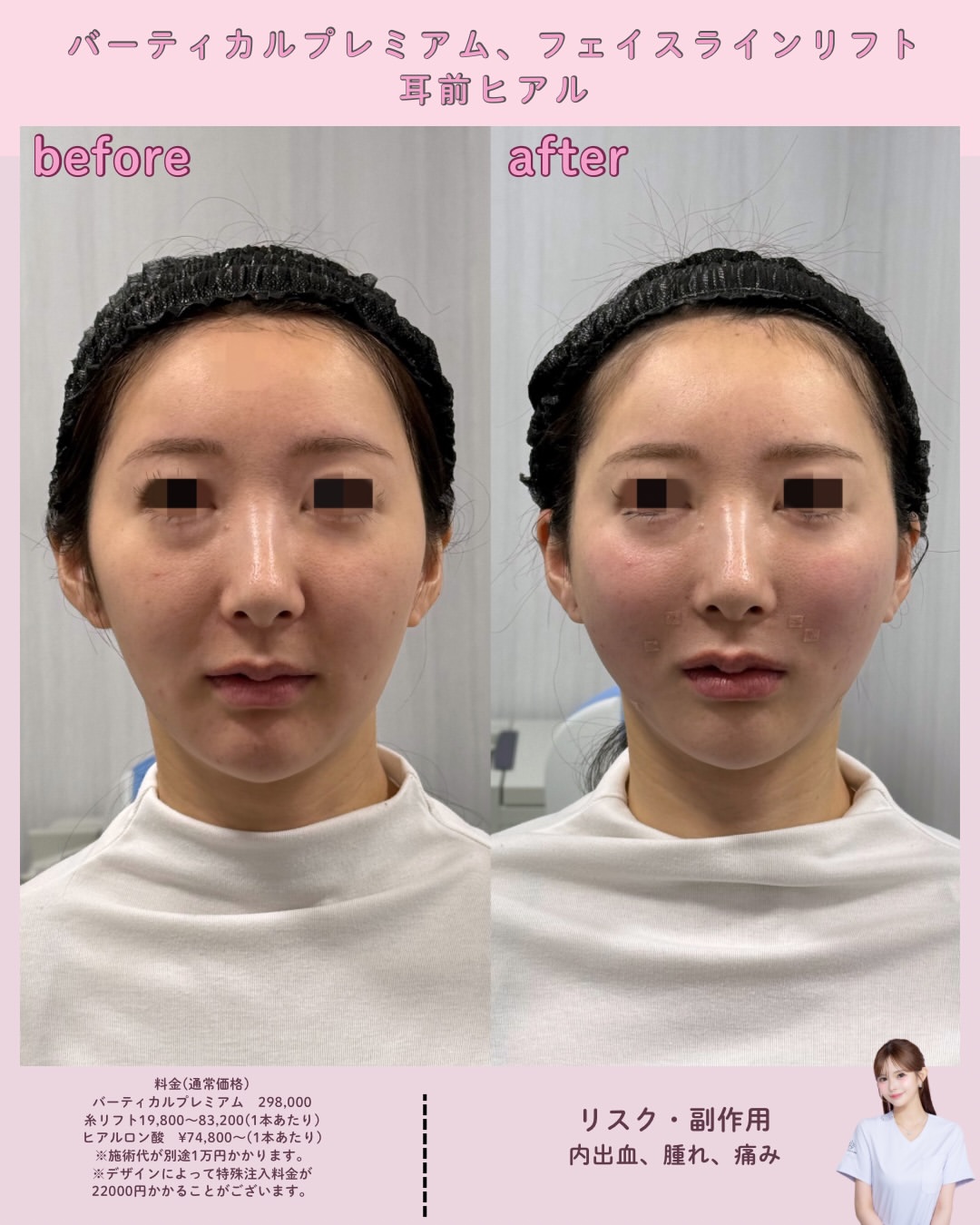 バーティカルプレミアム×フェイスラインリフト×ヒアルロン酸