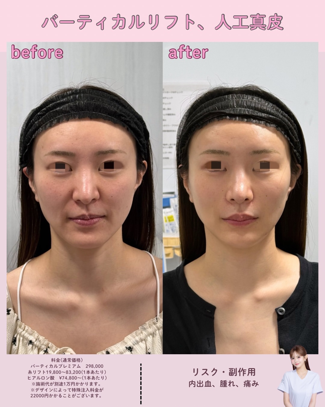 バーティカルリフトプレミアム