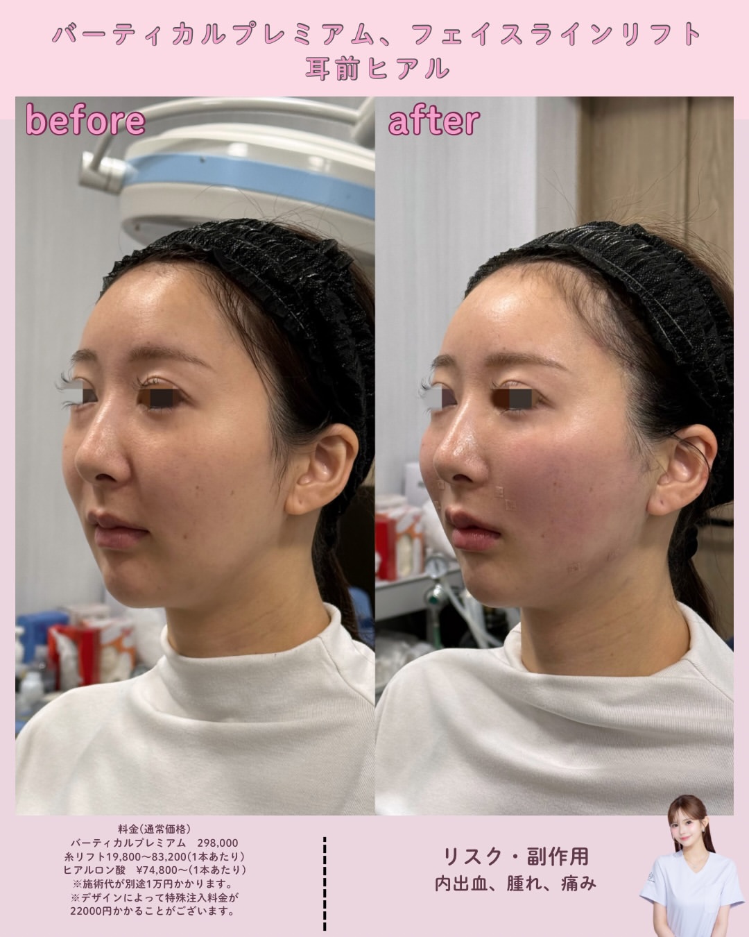 バーティカルプレミアム×フェイスラインリフト×ヒアルロン酸