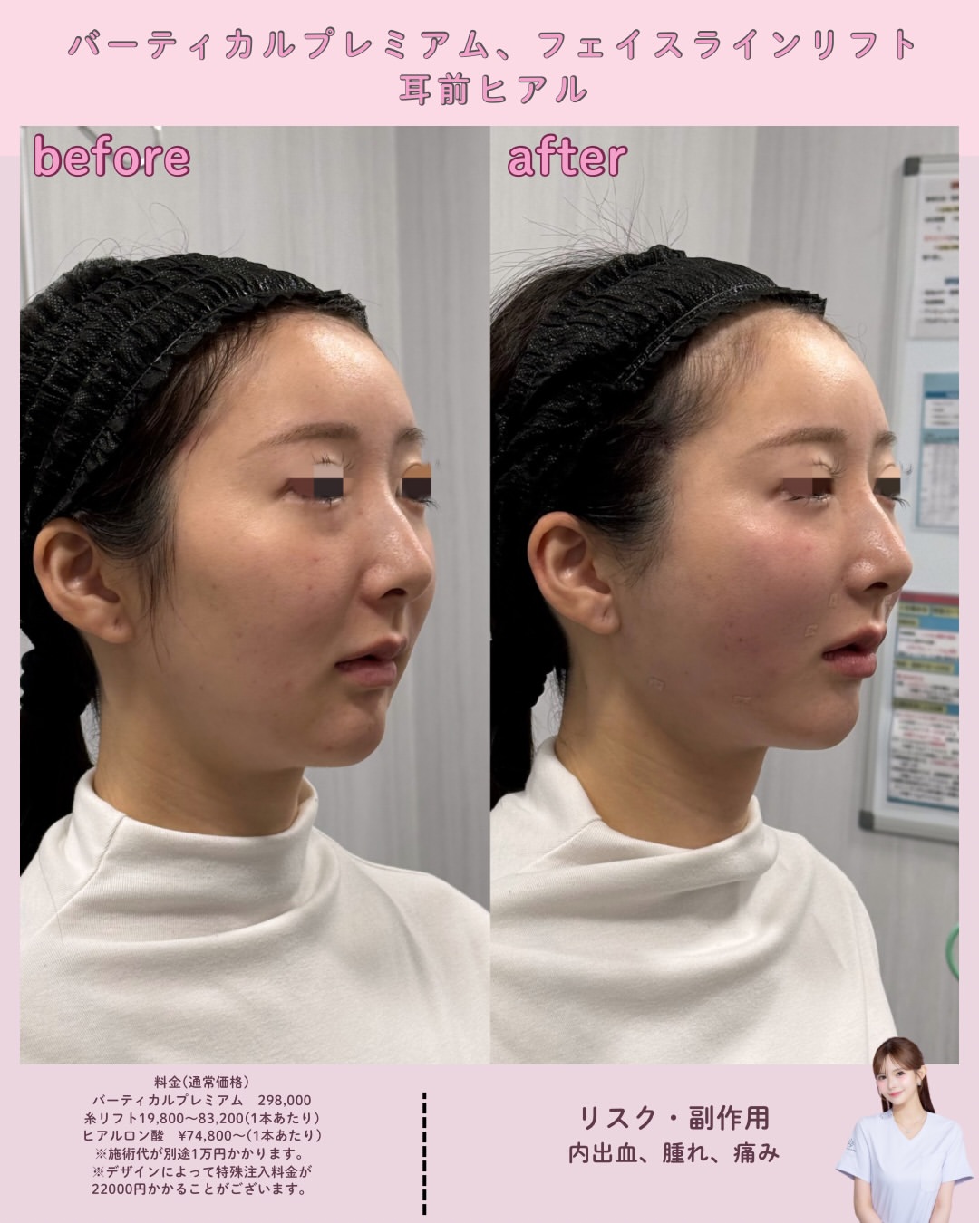 バーティカルプレミアム×フェイスラインリフト×ヒアルロン酸