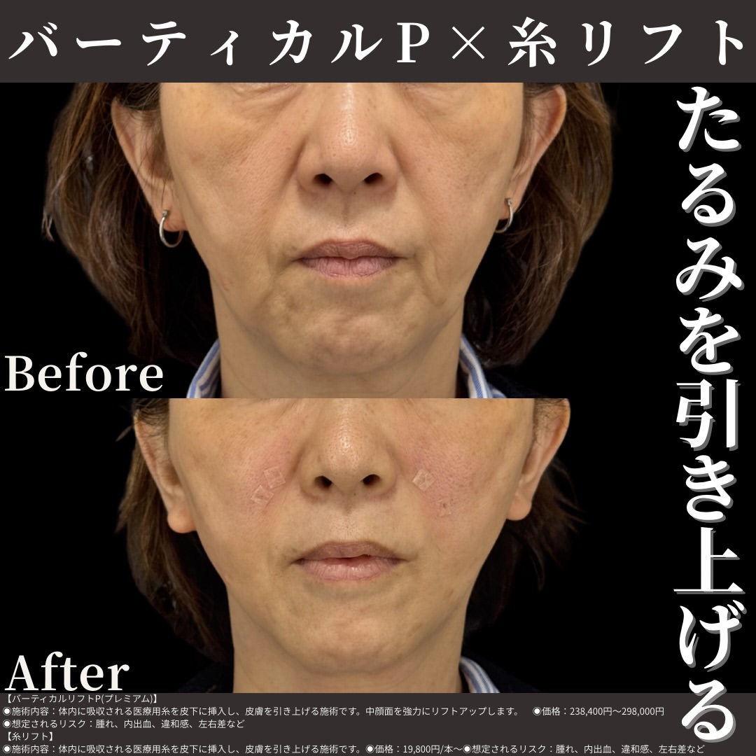 バーティカルリフトプレミアム×糸リフト