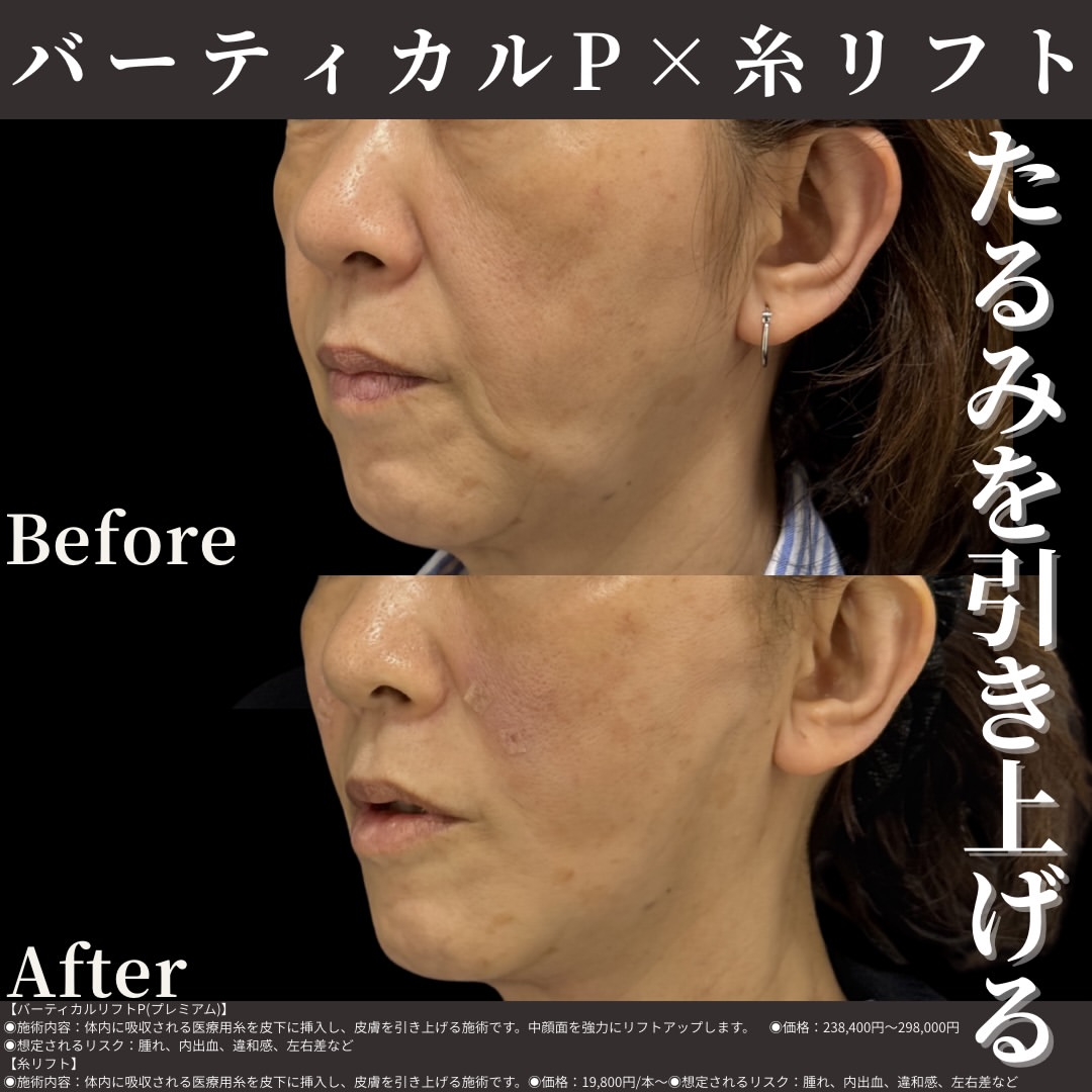 バーティカルリフトプレミアム×糸リフト