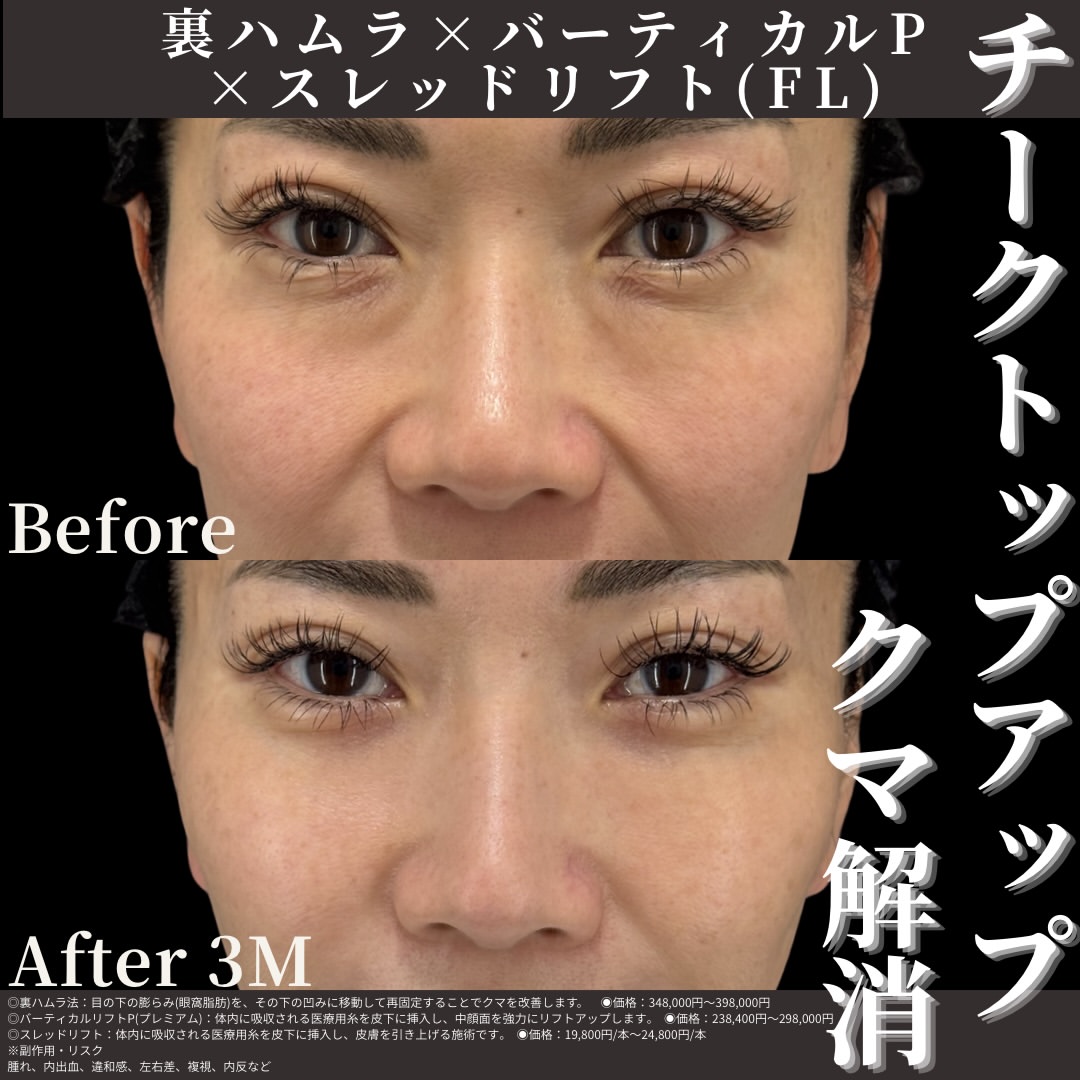裏ハムラ法×バーティカルP×スレッドリフト