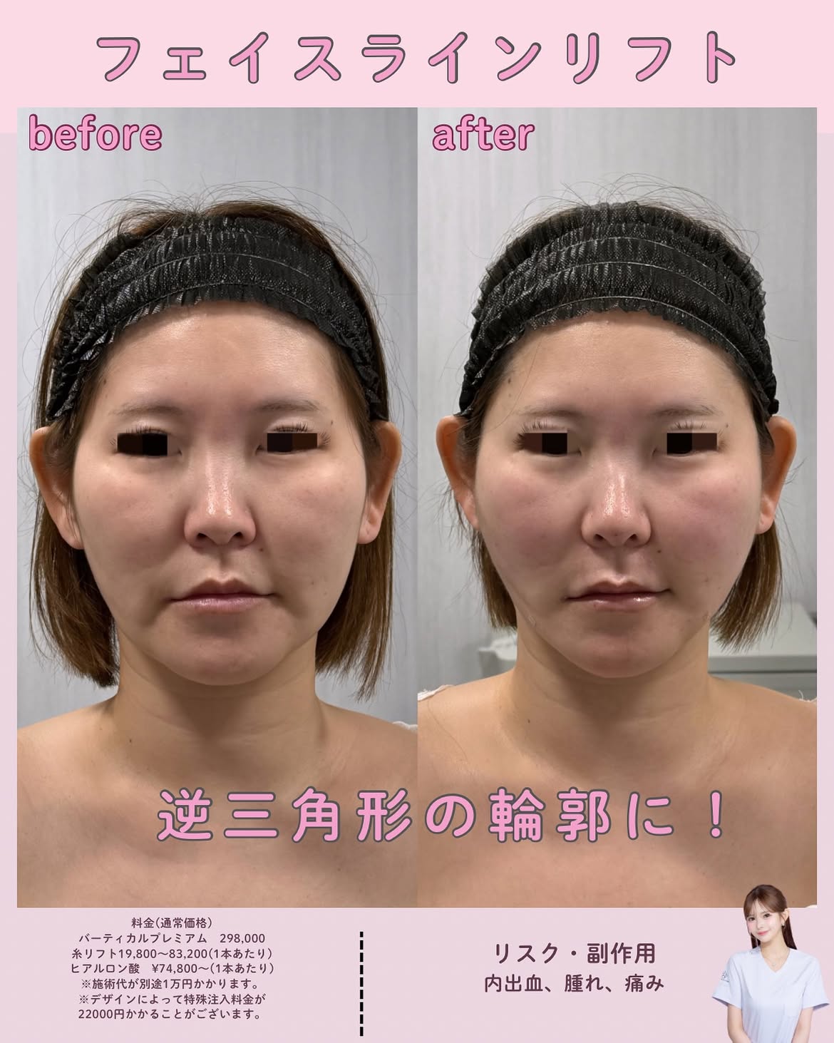 フェイスラインリフト