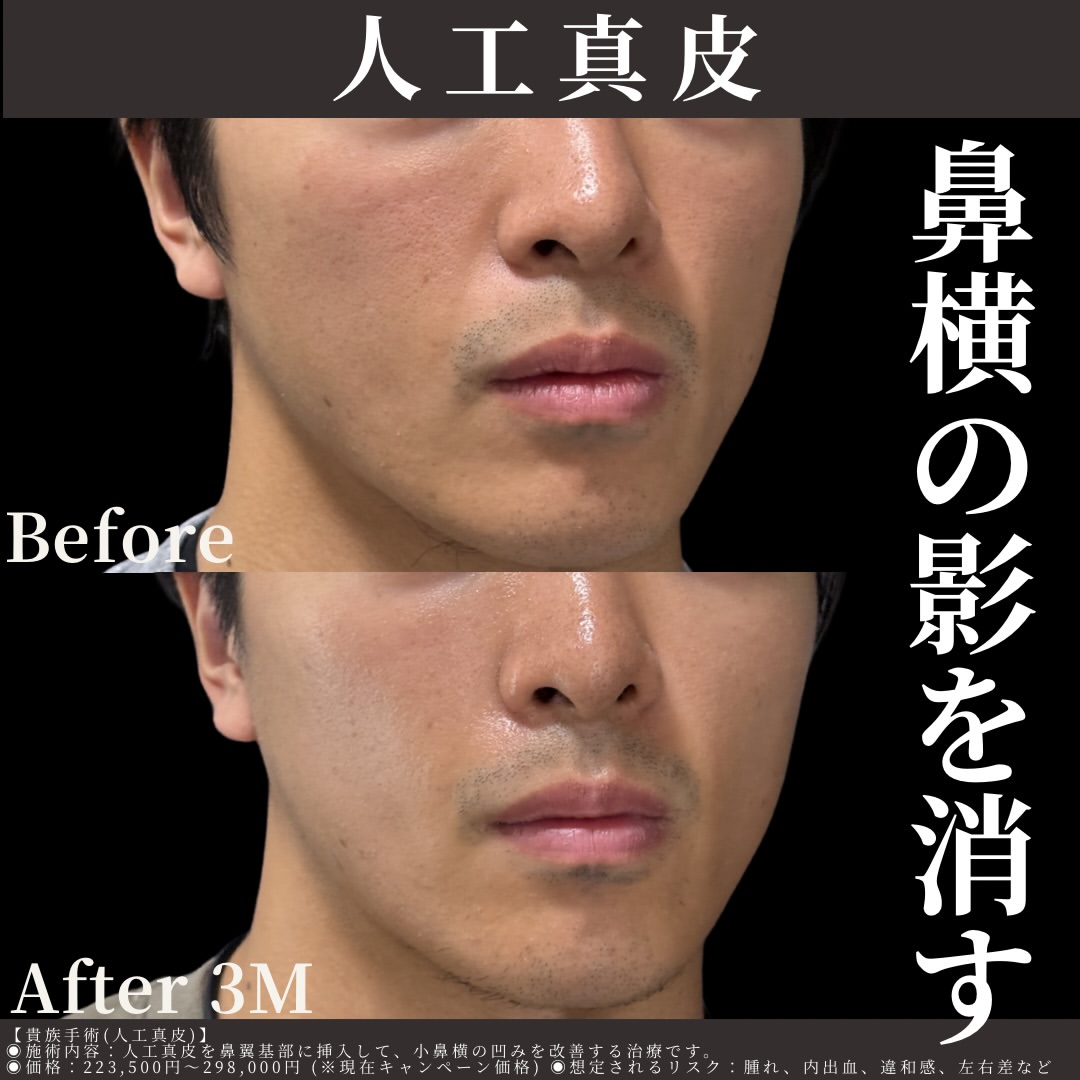 人工真皮