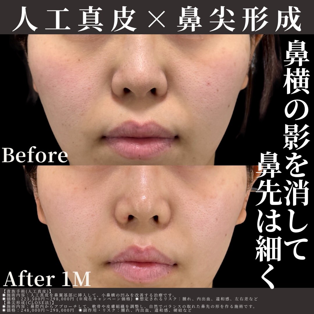 人工真皮×鼻尖形成