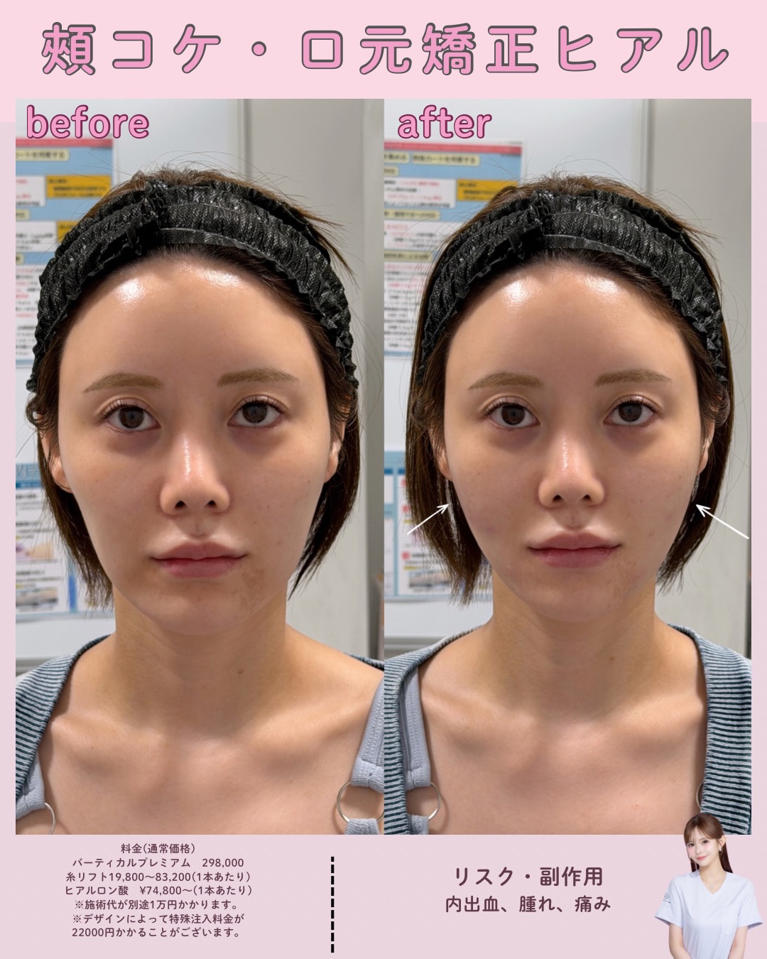 ヒアルロン酸