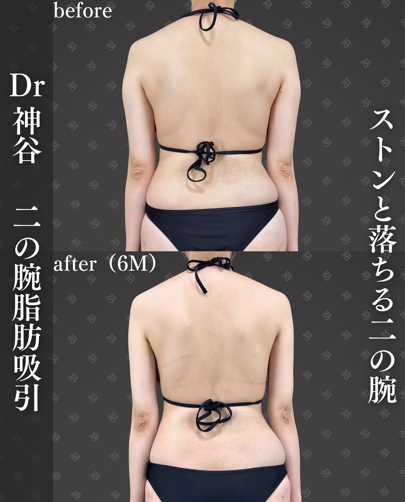 脂肪吸引ー症例写真