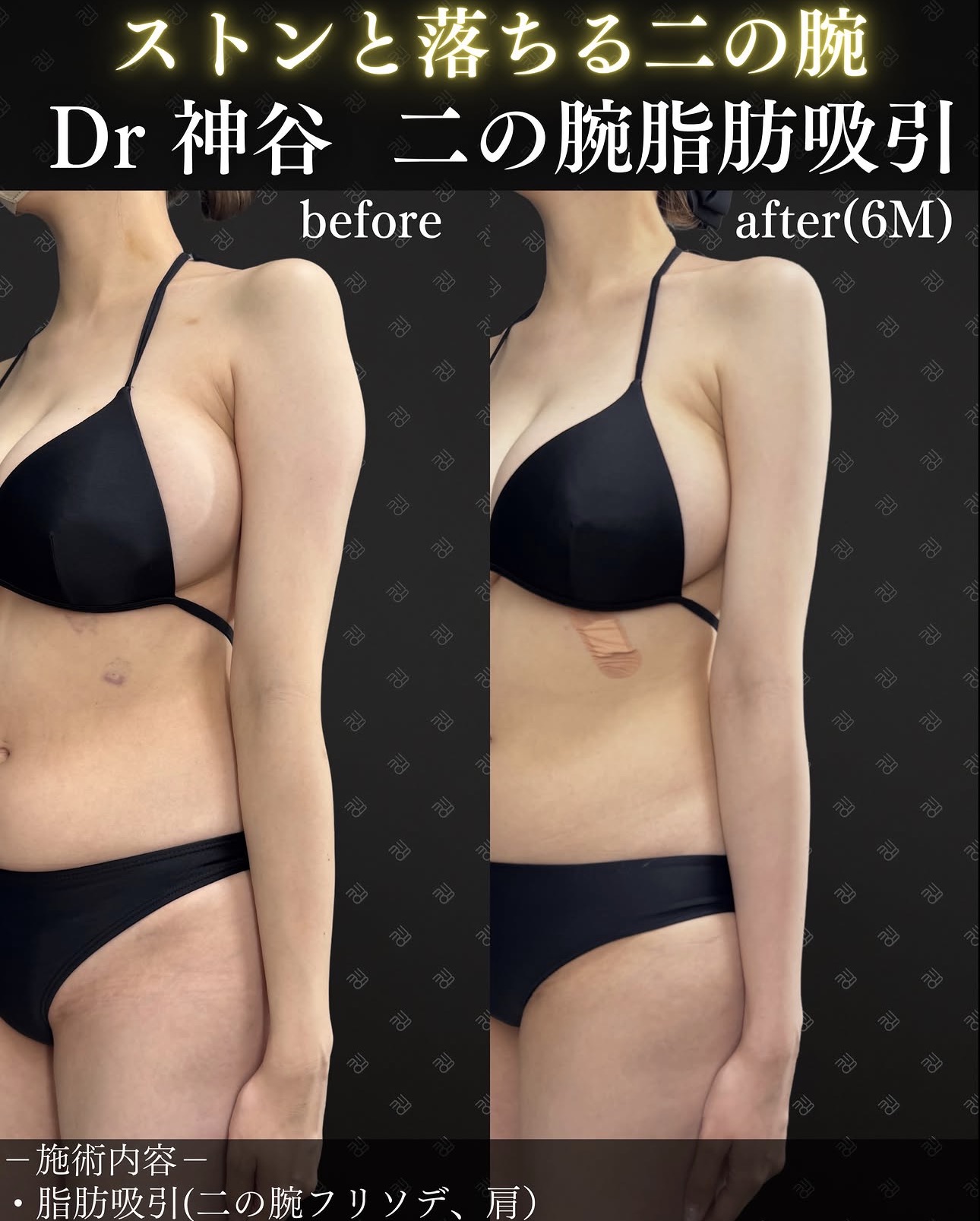 脂肪吸引ー症例写真