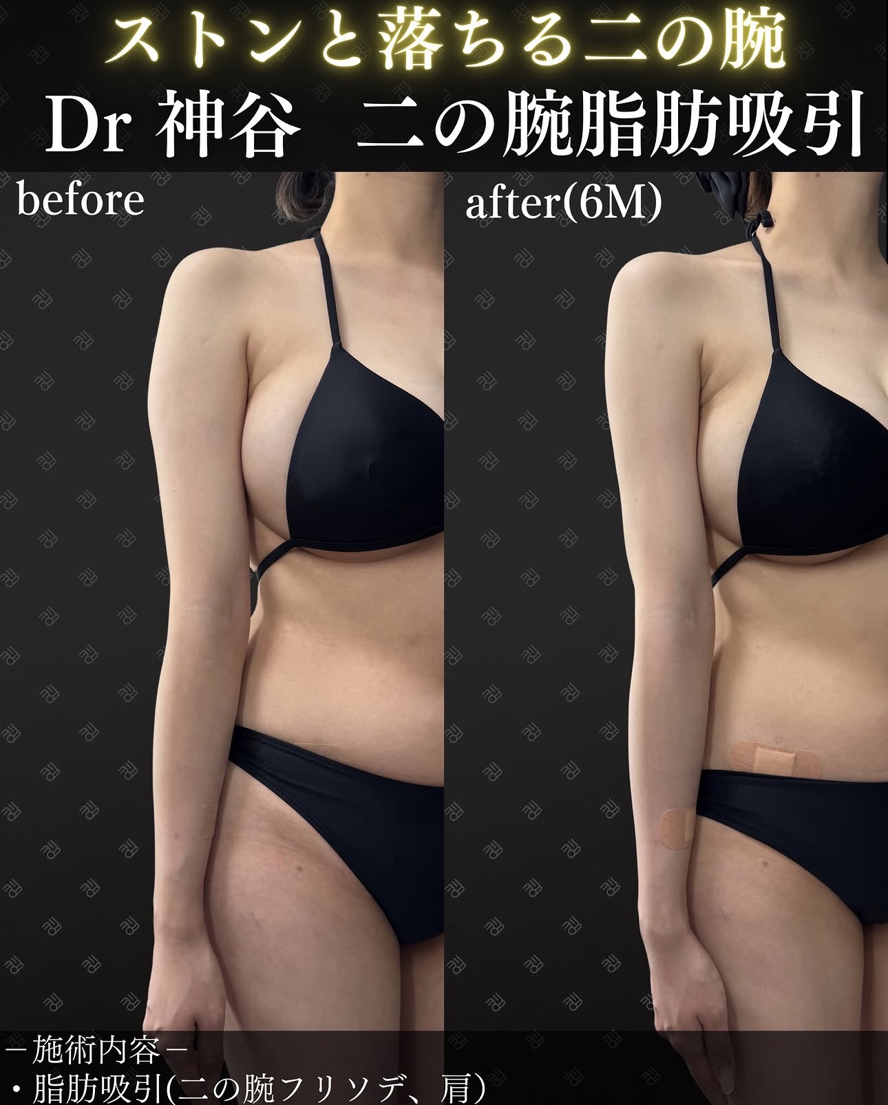 脂肪吸引ー症例写真