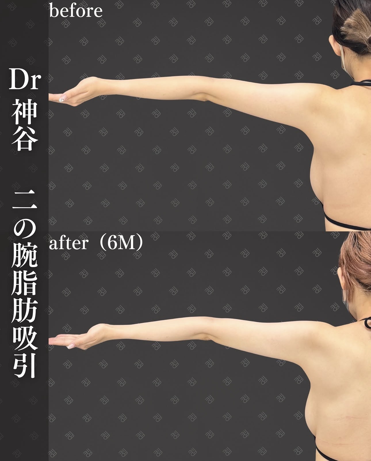 脂肪吸引ー症例写真