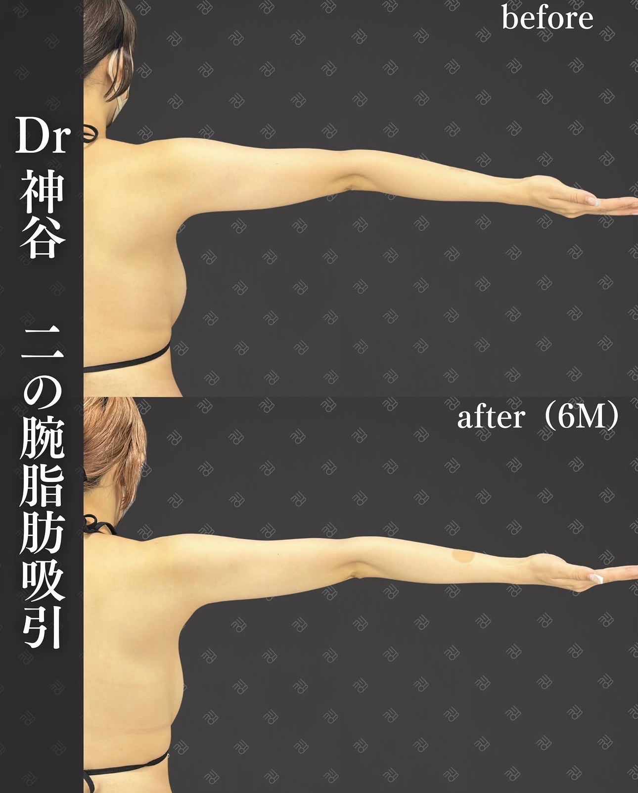 脂肪吸引ー症例写真