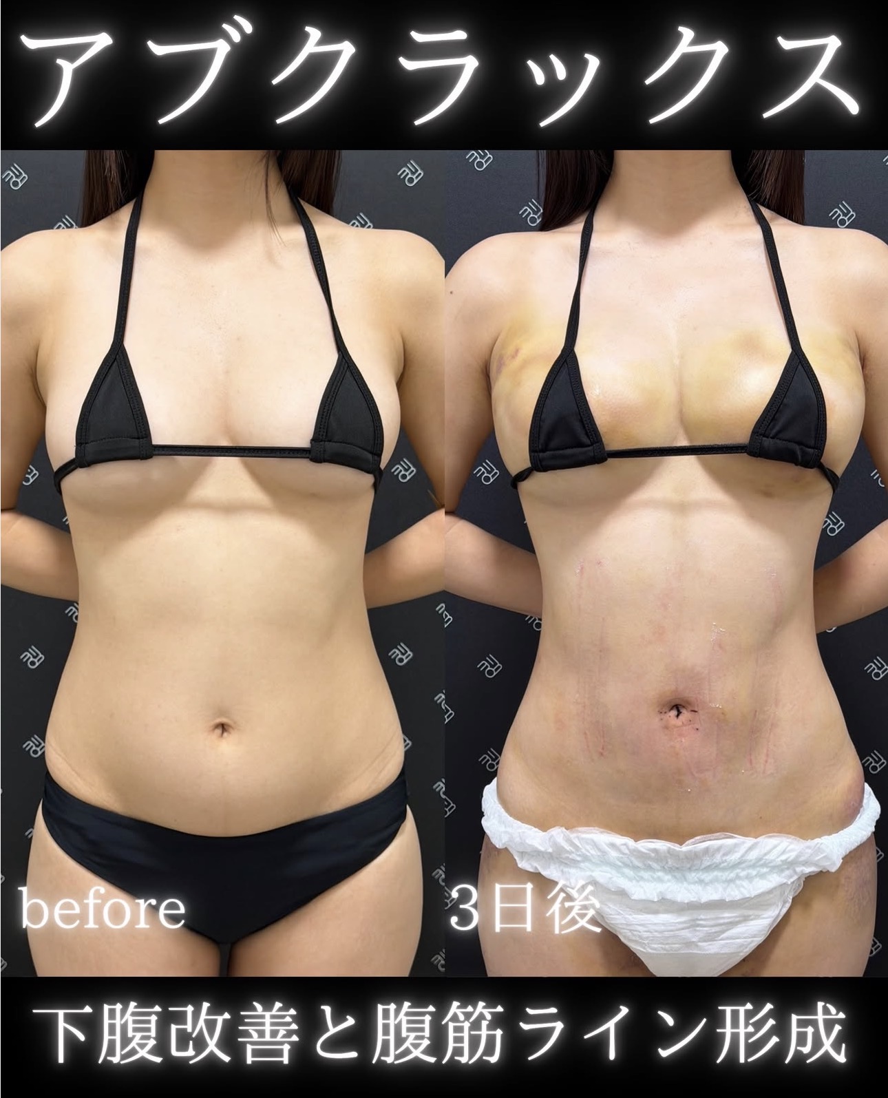 腹部脂肪吸引ー症例写真