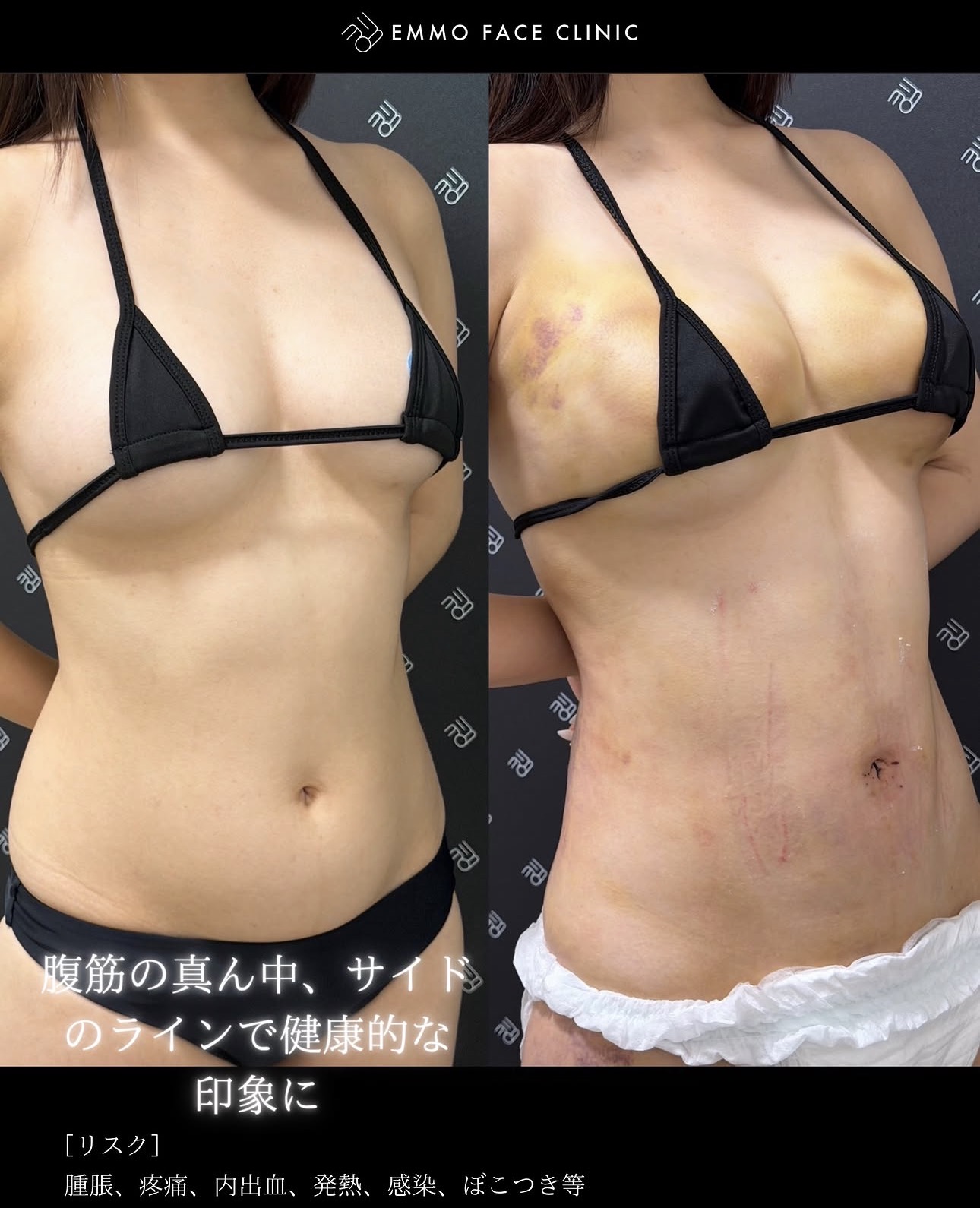 腹部脂肪吸引ー症例写真