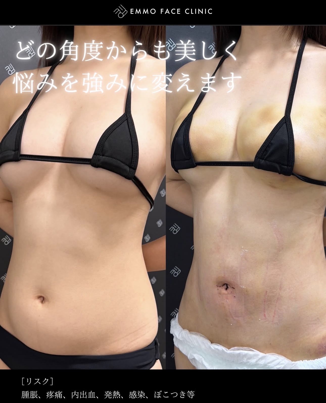 腹部脂肪吸引ー症例写真