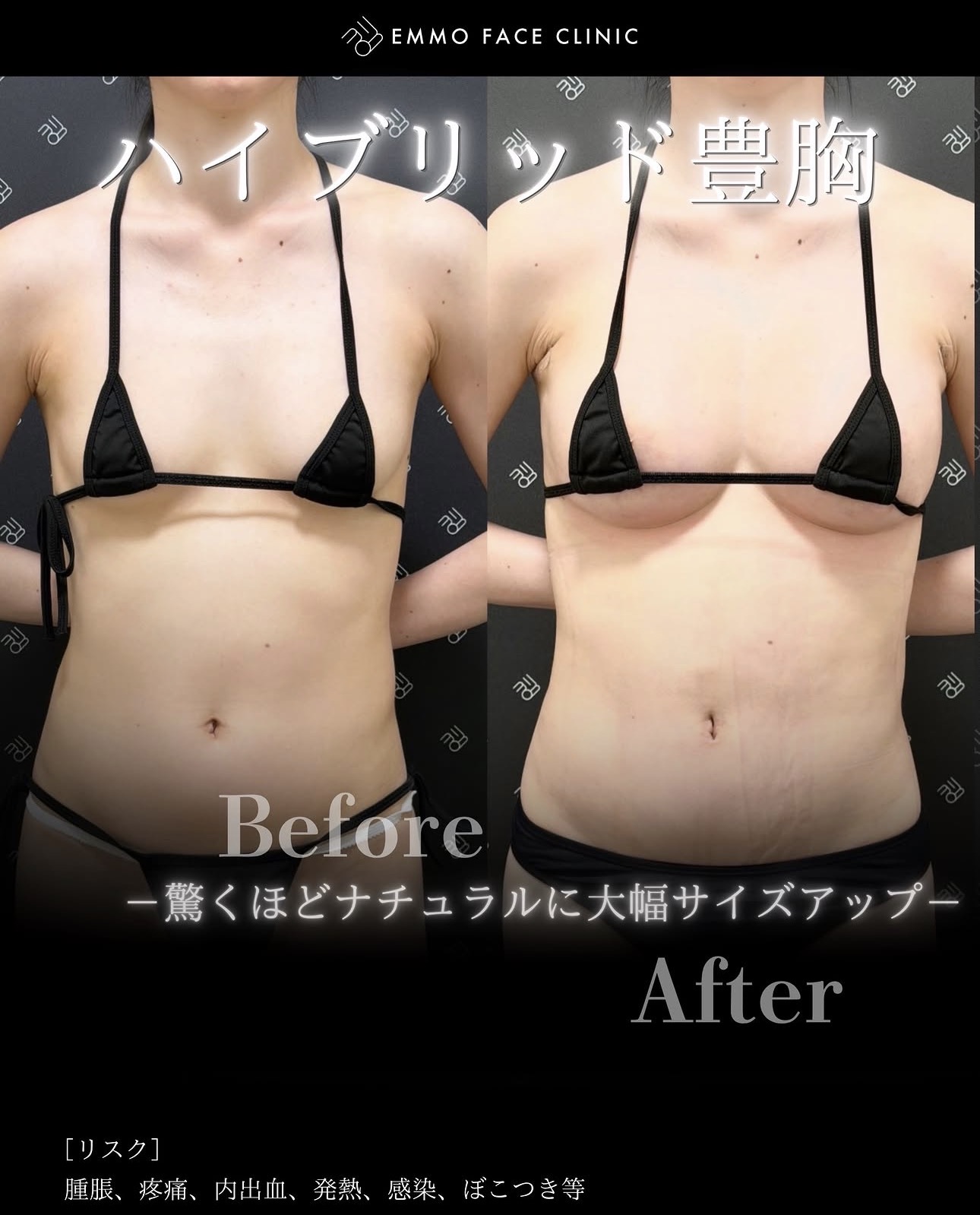 豊胸ー症例写真