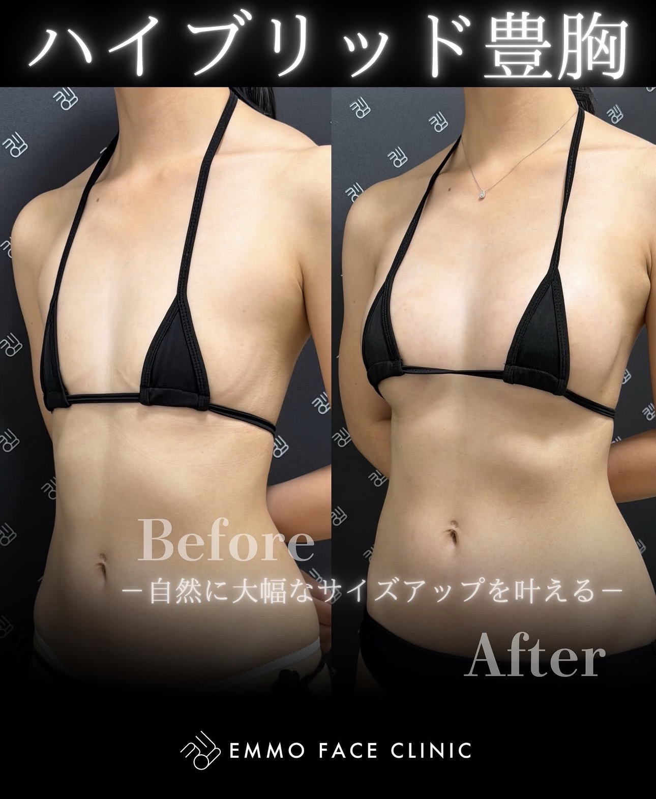 豊胸ー症例写真