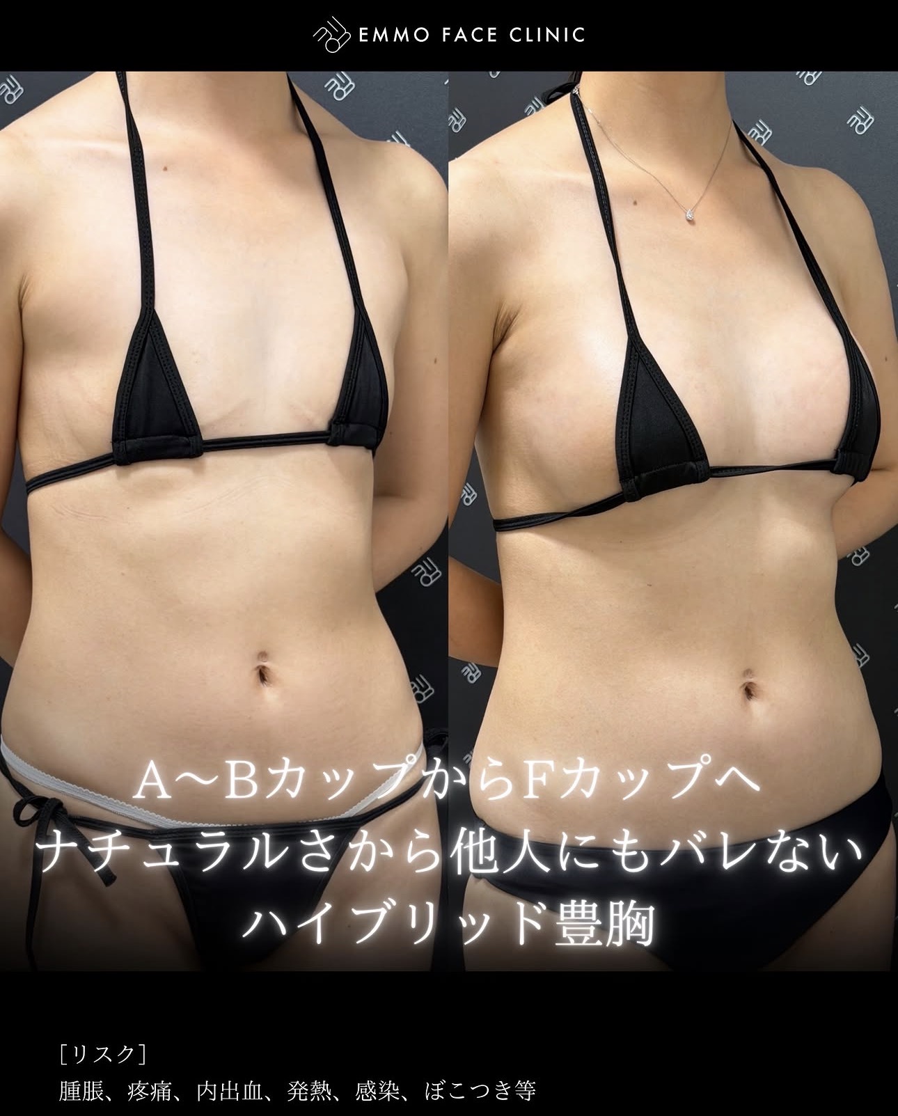 豊胸ー症例写真
