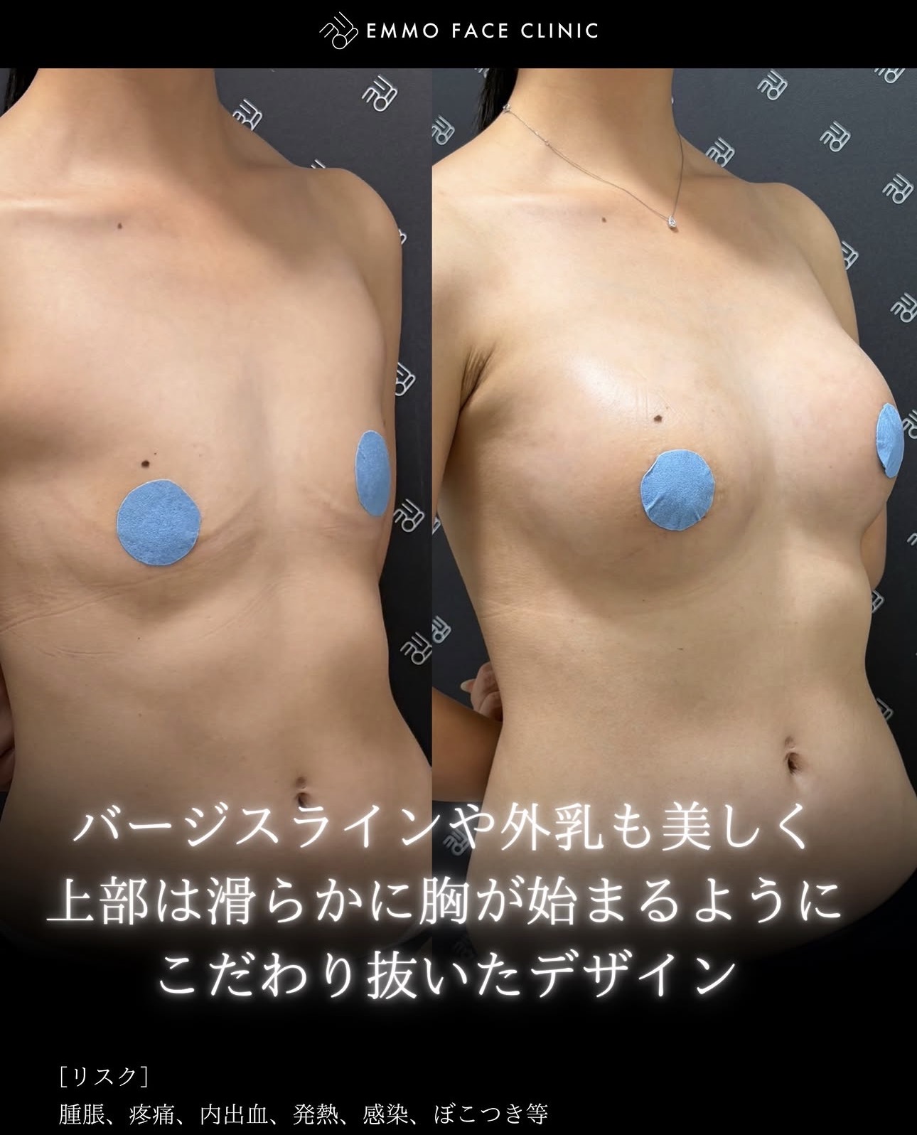 豊胸ー症例写真